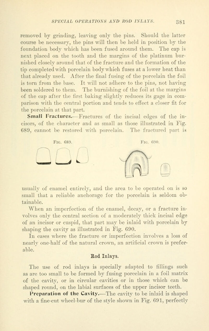 removed by grinding, leaving only the pins. Should the latter course be necessary, the pins will then be held in position by the foundation body which has been fused around them. The cap is next placed on the tooth and the margins of the platinum bur- nished closely around that of the fracture and the formation of the tip completed with porcelain body which fuses at a lower heat than that already used. After the final fusing of the porcelain the foil is torn from the base. It will not adhere to the pins, not having been soldered to them. The burnishing of the foil at the margins of the cap after the first baking slightly reduces its gage in com- parison with the central portion and tends to effect a closer fit for the porcelain at that part. Small Fractures.-—Fractures of the incisal edges of the in- cisors, of the character and as small as those illustrated in Fig. 689, cannot be restored with porcelain. The fractured part is Fig. 689. Fig. 690. usually of enamel entirely, and the area to be operated on is so small that a reliable anchorage for the porcelain is seldom ob- tainable. When an imperfection of the enamel, decay, or a fracture in- volves only the central section of a moderately thick incisal edge of an incisor or cuspid, that part may be inlaid with porcelain by shaping the cavity as illustrated in Fig. 690. In cases where the fracture or imperfection involves a loss of nearly one-half of the natural crown, an artificial crown is prefer- able. Rod Inlays. The use of rod inlays is specially adapted to fillings such as are too small to be formed by fusing porcelain in a foil matrix of the cavity, or in circular cavities or in those which can be shaped round, on the labial surfaces of the upper incisor teeth. Preparation of the Cavity.—The cavity to be inlaid is shaped with a fine-cut wheel-bur of the style shown in Fig. 691, perfectly