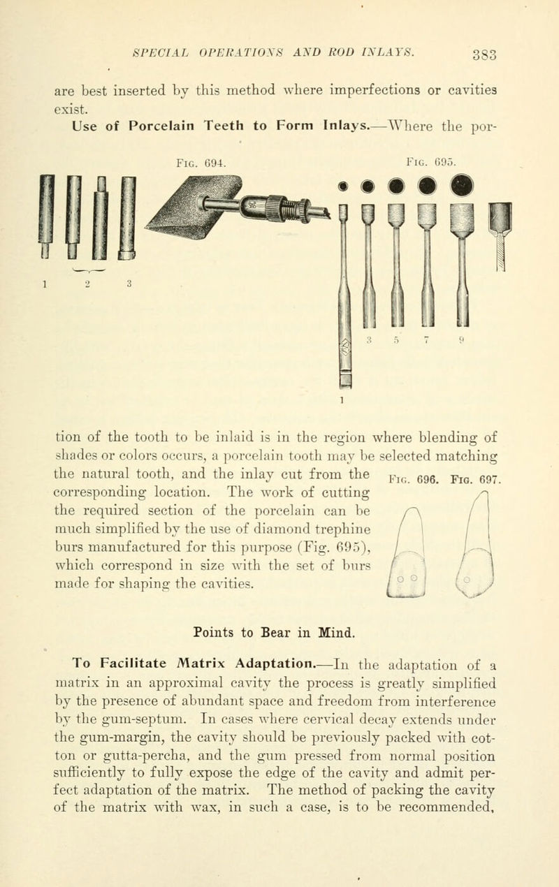 are best inserted by this method where imperfections or cavities exist. Use of Porcelain Teeth to Form Inlays.—Where the por- FlG. G94. Fig. G95. tion of the tooth to be inlaid is in the region where blending of shades or colors occurs, a porcelain tooth may be selected matching the natural tooth, and the inlay cut from the Fl(. 696 -pia 697 corresponding location. The work of cutting the required section of the porcelain can be much simplified by the use of diamond trephine burs manufactured for this purpose (Fig. 695), which correspond in size with the set of burs made for shaping the cavities. Points to Bear in Mind. To Facilitate Matrix Adaptation—In the adaptation of a matrix in an approximal cavity the process is greatly simplified by the presence of abundant space and freedom from interference by the gum-septum. In cases where cervical decay extends under the gum-margin, the cavity should be previously packed with cot- ton or gutta-percha, and the gum pressed from normal position sufficiently to fully expose the edge of the cavity and admit per- fect adaptation of the matrix. The method of packing the cavity of the matrix with wax, in such a case, is to be recommended,