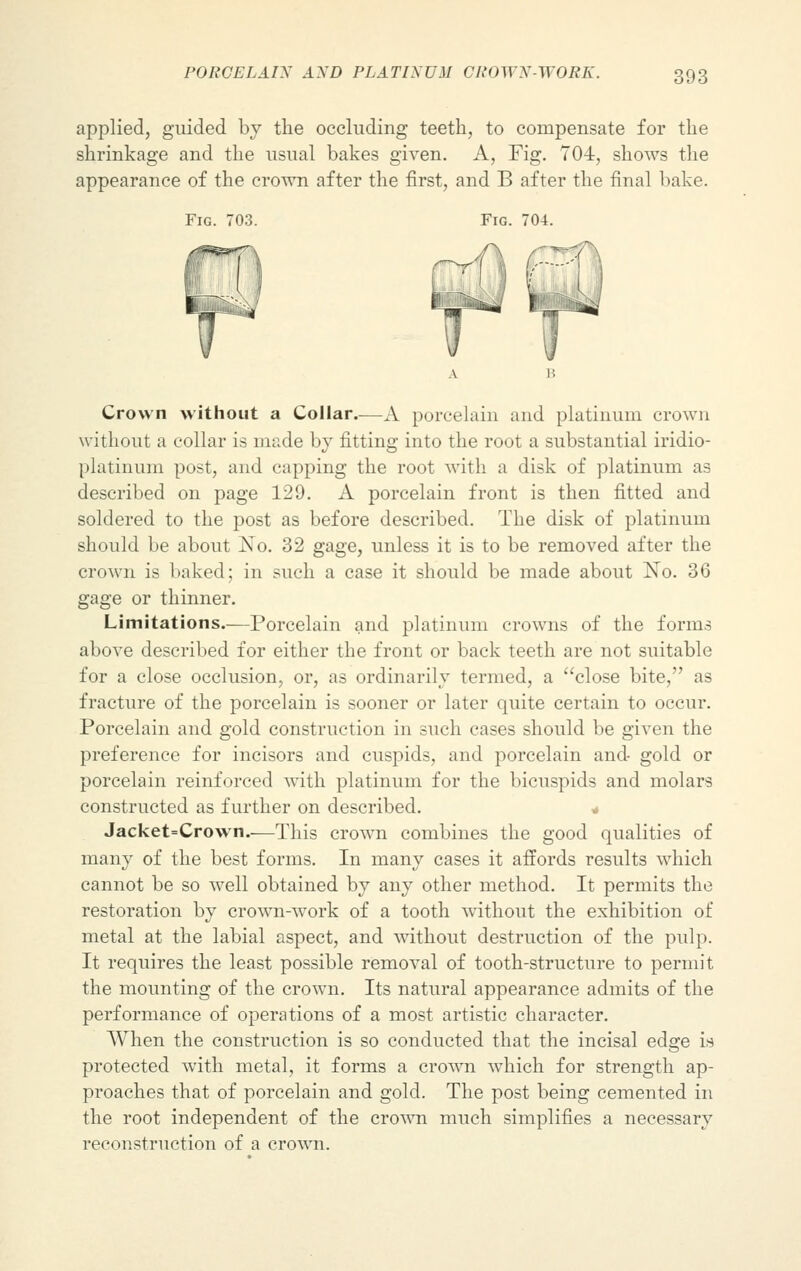 applied, guided by the occluding teeth, to compensate for the shrinkage and the usual bakes given. A, Fig. 704, shows the appearance of the crown after the first, and B after the final bake. Fig. 703. Fig. 704. Crown without a Collar—A porcelain and platinum crown without a collar is made by fitting into the root a substantial iridio- platinum post, and capping the root with a disk of platinum as described on page 129. A porcelain front is then fitted and soldered to the post as before described. The disk of platinum should be about No. 32 gage, unless it is to be removed after the crown is baked; in such a case it should be made about No. 36 gage or thinner. Limitations.—Porcelain and platinum crowns of the forms above described for either the front or back teeth are not suitable for a close occlusion, or, as ordinarily termed, a close bite, as fracture of the porcelain is sooner or later quite certain to occur. Porcelain and gold construction in such cases should be given the preference for incisors and cuspids, and porcelain and- gold or porcelain reinforced with platinum for the bicuspids and molars constructed as further on described. 4 Jacket=Crown—This crown combines the good qualities of many of the best forms. In many cases it affords results which cannot be so well obtained by any other method. It permits the restoration by crown-work of a tooth without the exhibition of metal at the labial aspect, and without destruction of the pulp. It requires the least possible removal of tooth-structure to permit the mounting of the crown. Its natural appearance admits of the performance of operations of a most artistic character. When the construction is so conducted that the incisal edge is protected with metal, it forms a crown which for strength ap- proaches that of porcelain and gold. The post being cemented in the root independent of the crown much simplifies a necessary reconstruction of a crown.