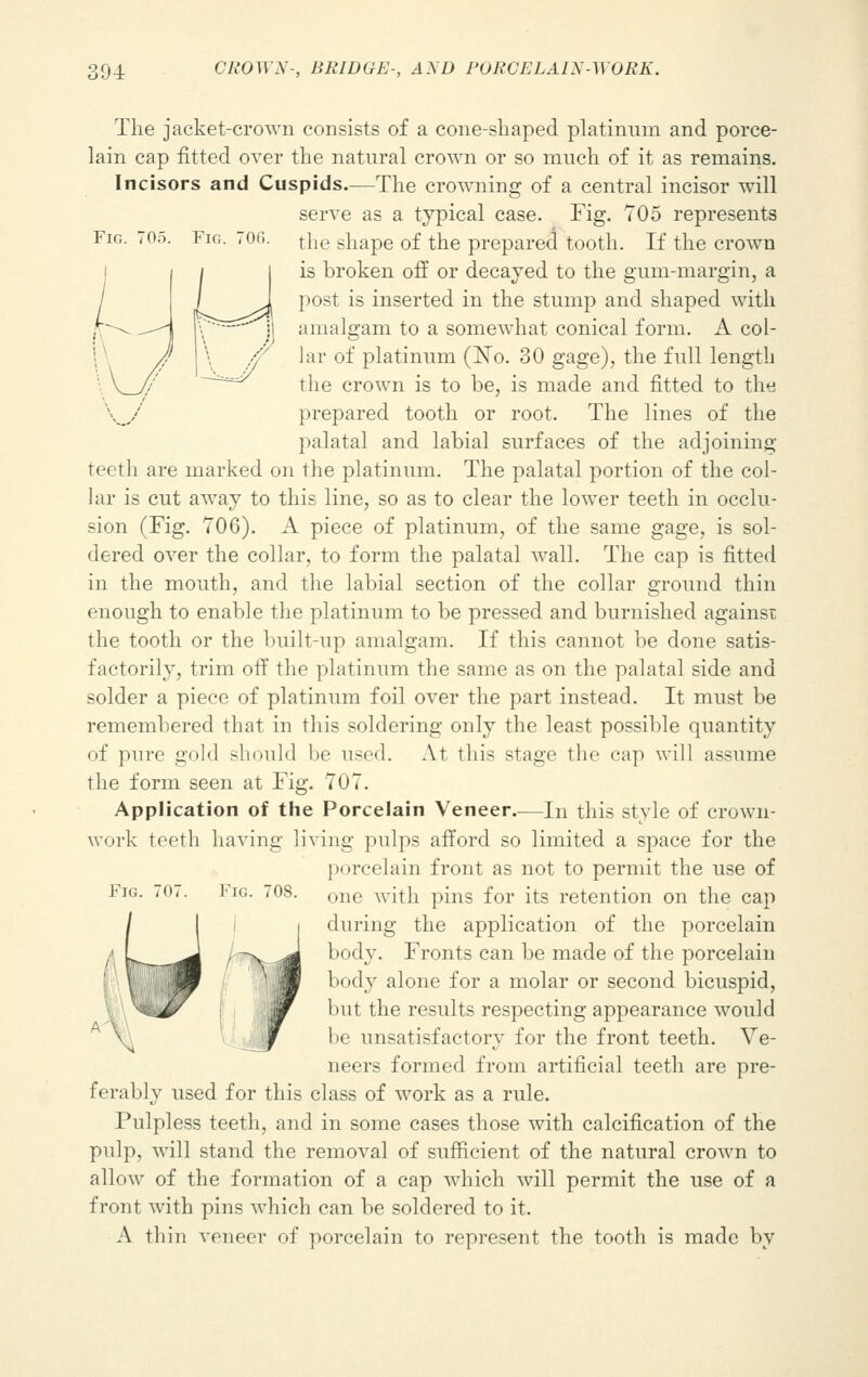 Fig. 705. Fig. 70fi. The jacket-crown consists of a cone-shaped platinum and porce- lain cap fitted over the natural crown or so much of it as remains. Incisors and Cuspids.—The crowning of a central incisor will serve as a typical case. Fig. 705 represents the shape of the prepared tooth. If the crown is broken off or decayed to the gum-margin, a post is inserted in the stump and shaped with amalgam to a somewhat conical form. A col- lar of platinum (No. 30 gage), the full length the crown is to be, is made and fitted to the \y prepared tooth or root. The lines of the palatal and labial surfaces of the adjoining teeth are marked on the platinum. The palatal portion of the col- lar is cut away to this line, so as to clear the lower teeth in occlu- sion (Fig. 706). A piece of platinum, of the same gage, is sol- dered over the collar, to form the palatal wall. The cap is fitted in the mouth, and the labial section of the collar ground thin enough to enable the platinum to be pressed and burnished against the tooth or the built-up amalgam. If this cannot be done satis- factorily, trim off the platinum the same as on the palatal side and solder a piece of platinum foil over the part instead. It must be remembered that in this soldering only the least possible quantity of pure gold should be used. At this stage the cap will assume the form seen at Fig. 707. Application of the Porcelain Veneer.—In this style of crown work teeth having living pulps afford so limited a space for the porcelain front as not to permit the use of one with pins for its retention on the cap during the application of the porcelain body. Fronts can be made of the porcelain body alone for a molar or second bicuspid, but the results respecting appearance would be unsatisfactory for the front teeth. Ve- neers formed from artificial teeth are pre- ferably used for this class of work as a rule. Pulpless teeth, and in some cases those with calcification of the pulp, will stand the removal of sufficient of the natural crown to allow of the formation of a cap which will permit the use of a front with pins which can be soldered to it. A tin'n veneer of porcelain to represent the tooth is made by Fig. 701 Fig. 708.