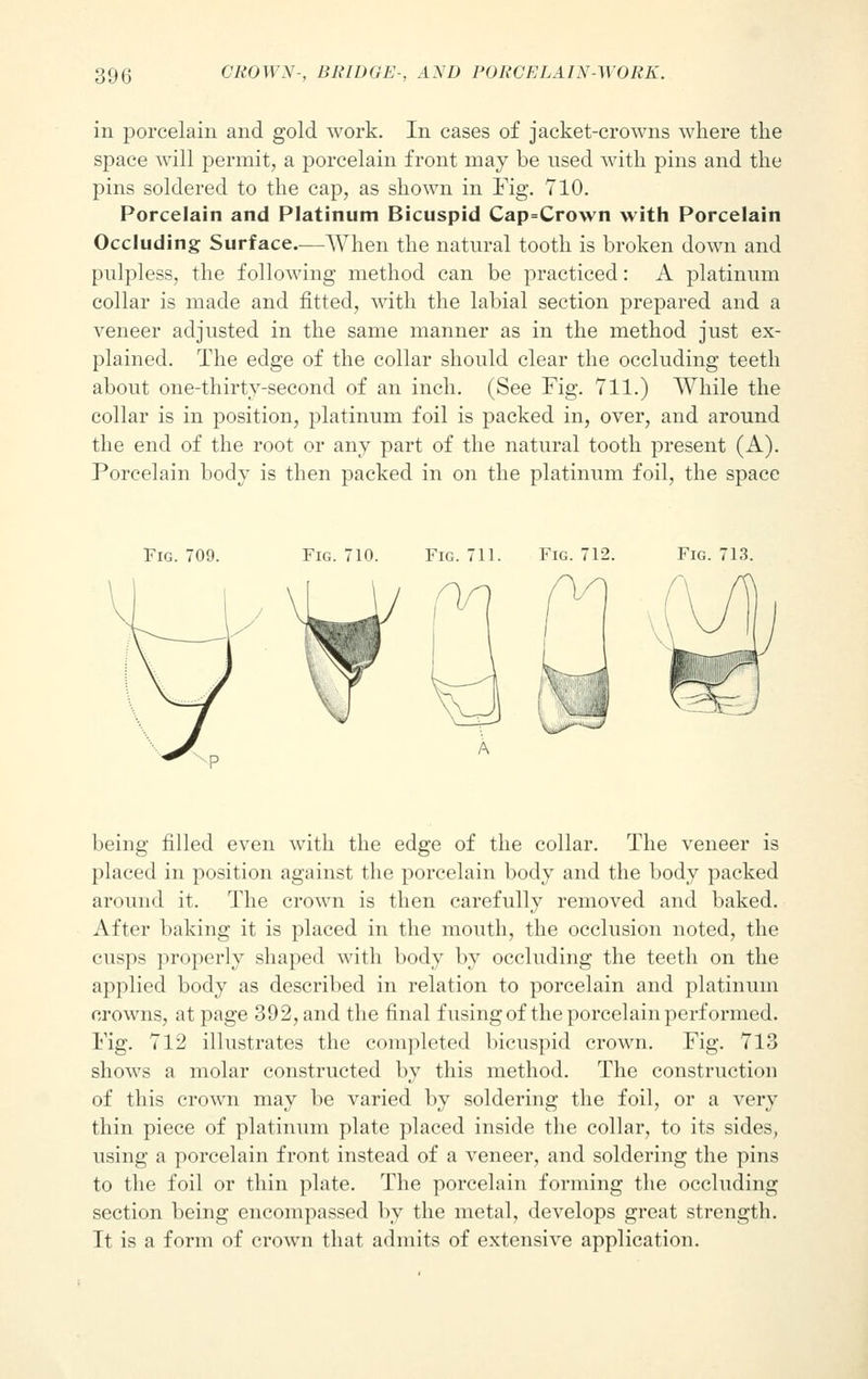 in porcelain and gold work. In cases of jacket-crowns where the space will permit, a porcelain front may be used with pins and the pins soldered to the cap, as shown in Fig. 710. Porcelain and Platinum Bicuspid Cap=Cro\vn with Porcelain Occluding Surface.—When the natural tooth is broken down and pulpless, the following method can be practiced: A platinum collar is made and fitted, with the labial section prepared and a veneer adjusted in the same manner as in the method just ex- plained. The edge of the collar should clear the occluding teeth about one-thirty-second of an inch. (See Fig. 711.) While the collar is in position, platinum foil is packed in, over, and around the end of the root or any part of the natural tooth present (A). Porcelain body is then packed in on the platinum foil, the space Fig. 709. Fig. 710. Fig. 711. Fig. 712. Fig. 713. being filled even with the edge of the collar. The veneer is placed in position against the porcelain body and the body packed around it. The crown is then carefully removed and baked. After baking it is placed in the mouth, the occlusion noted, the cusps properly shaped with body by occluding the teeth on the applied body as described in relation to porcelain and platinum crowns, at page 392, and the final fusing of the porcelain performed. Fig. 712 illustrates the completed bicuspid crown. Fig. 713 shows a molar constructed by this method. The construction of this crown may be varied by soldering the foil, or a very thin piece of platinum plate placed inside the collar, to its sides, using a porcelain front instead of a veneer, and soldering the pins to the foil or thin plate. The porcelain forming the occluding section being encompassed by the metal, develops great strength. It is a form of crown that admits of extensive application.
