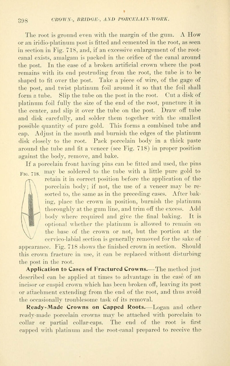 The root is ground even with the margin of the gum. A How or an iridio-platinum post is fitted and cemented in the root, as seen in section in Fig. 718, and, if an excessive enlargement of the root- canal exists, amalgam is packed in the orifice of the canal around the post. In the case of a broken artificial crown where the post remains with its end protruding from the root, the tube is to be shaped to fit over the post. Take a piece of wire, of the gage of the post, and twist platinum foil around it so that the foil shall form a tube. Slip the tube on the post in the root. Cut a disk of platinum foil fully the size of the end of the root, puncture it in the center, and slip it over the tube on the post. Draw off tube and disk carefully, and solder them together with the smallest possible quantity of pure gold. This forms a combined tube and cap. Adjust in the mouth and burnish the edges of the platinum disk closely to the root. Pack porcelain body in a thick paste around the tube and fit a veneer (see Tig. 718) in proper position against the body, remove, and bake. If a porcelain front having pins can be fitted and used, the pins Fig 718 ma^ ^e s°ldered to the tube with a little pure gold to retain it in correct position before the application of the porcelain body; if not, the use of a veneer may be re- sorted to, the same as in the preceding cases. After bak- ing, place the crown in position, burnish the platinum thoroughly at the gum line, and trim off the excess. Add body where required and give the final baking. It is optional whether the platinum is allowed to remain on the base of the crown or not, but the portion at the cervico-labial section is generally removed for the sake of appearance. Fig. 718 shows the finished crown in section. Should this crown fracture in use, it can be replaced without disturbing the post in the root. Application to Cases of Fractured Crowns.—The method just described can be applied at times to advantage in the case of an incisor or cuspid crown which has been broken off, leaving its post or attachment extending from the end of the root, and thus avoid the occasionally troublesome task of its removal. Ready=Made Crowns on Capped Roots—Logan and other ready-made porcelain crowns may be attached with porcelain to collar or partial collar-caps. The end of the root is first capped with platinum and the root-canal prepared to receive the