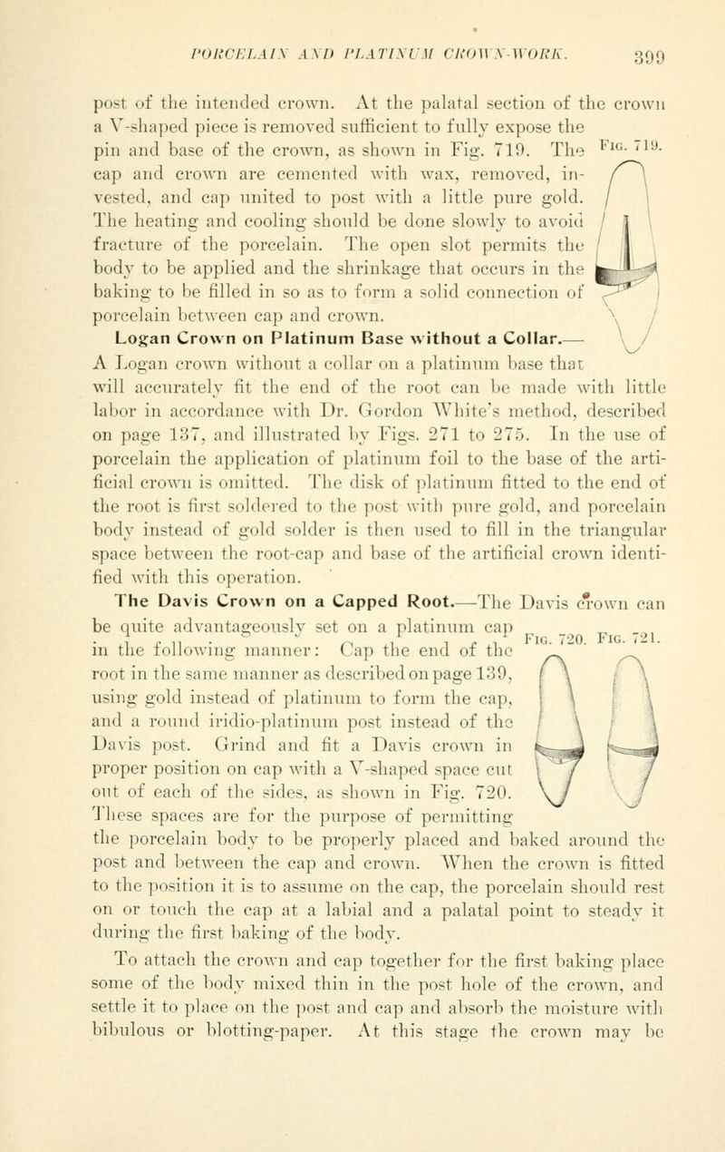 post of the intended crown. At the palatal section of the crown a V-shaped piece is removed sufficient to fully expose the pin and base of the crown, as shown in Fig. 719. The cap and crown are cemented with wax, removed, in- vested, and cap united to post with a little pure gold. The heating and cooling should be done slowly to avoid fracture of the porcelain. The open slot permits the body to be applied and the shrinkage that occurs in the baking to be filled in so as to form a solid connection of porcelain between cap and crown. Logan Crown on Platinum Base without a Collar.— A Logan crown without a collar on a platinum base that will accurately fit the end of the root can be made with little labor in accordance with Dr. Gordon White's method, described on page 137, and illustrated by Figs. 271 to 275. In the use of porcelain the application of platinum foil to the base of the arti- ficial crown is omitted. The disk of platinum fitted to the end of the root is first soldered to the post with pure gold, and porcelain body instead of gold solder is then used to fill in the triangular space between the root-cap and base of the artificial crown identi- fied with this operation. The Davis Crown on a Capped Root.—The Davis crown can be quite advantageously set on a platinum cap in the following manner: Cap the end of the root in the same manner as described on page 139, using gold instead of platinum to form the cap, and a round iridio-platinum post instead of the Davis post. (Jrind and fit a Davis crown in proper position on cap with a V-shaped space cut out of each of the sides, as shown in Fig. 720. 1 liese spaces are for the purpose of permitting the porcelain body to be properly placed and baked around the post and between the cap and crown. When the crown is fitted to the position it is to assume on the cap, the porcelain should rest on or touch the cap at a labial and a palatal point to steady it during the first baking of the body. To attach the crown and cap together for the first baking place some of the body mixed thin in the post hole of the crown, and settle it to place on the post and cap and absorb the moisture with bibulous or blotting-paper. At this stage the crown may be Fig. 72(). Fig. 721.