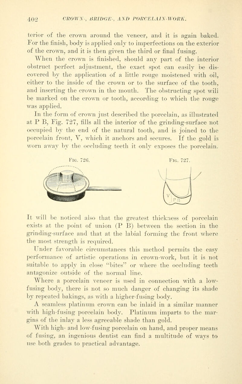 terior of the crown around the veneer, and it is again baked. For the finish, body is applied only to imperfections on the exterior of the crown, and it is then given the third or final fusing. When the crown is finished, should any part of the interior obstruct perfect adjustment, the exact spot can easily be dis- covered by the application of a little rouge moistened with oil, either to the inside of the crown or to the surface of the tooth, and inserting the crown in the mouth. The obstructing spot will be marked on the crown or tooth, according to which the rouge was applied. In the form of crown just described the porcelain, as illustrated at P B, Fig. 727, fills all the interior of the grinding-surface not occupied by the end of the natural tooth, and is joined to the porcelain front, V, which it anchors and secures. If the gold is worn away by the occluding teeth it only exposes the porcelain. Fig. 72G. Fig. It will be noticed also that the greatest thickness of porcelain exists at the point of union (P B) between the section in the grinding-surface and that at the labial forming the front where the most strength is required. Under favorable circumstances this method permits the easy performance of artistic operations in crown-work, but it is not suitable to apply in close bites or where the occluding teeth antagonize outside of the normal line. Where a porcelain veneer is used in connection with a low- fusing body, there is not so much danger of changing its shade by repeated bakings, as with a higher-fusing body. A seamless platinum crown can be inlaid in a similar manner with high-fusing porcelain body. Platinum imparts to the mar- gins of the inlay a less agreeable shade than gold. With high- and low-fusing porcelain on hand, and proper means of fusing, an ingenious dentist can find a multitude of ways to use both grades to practical advantage.