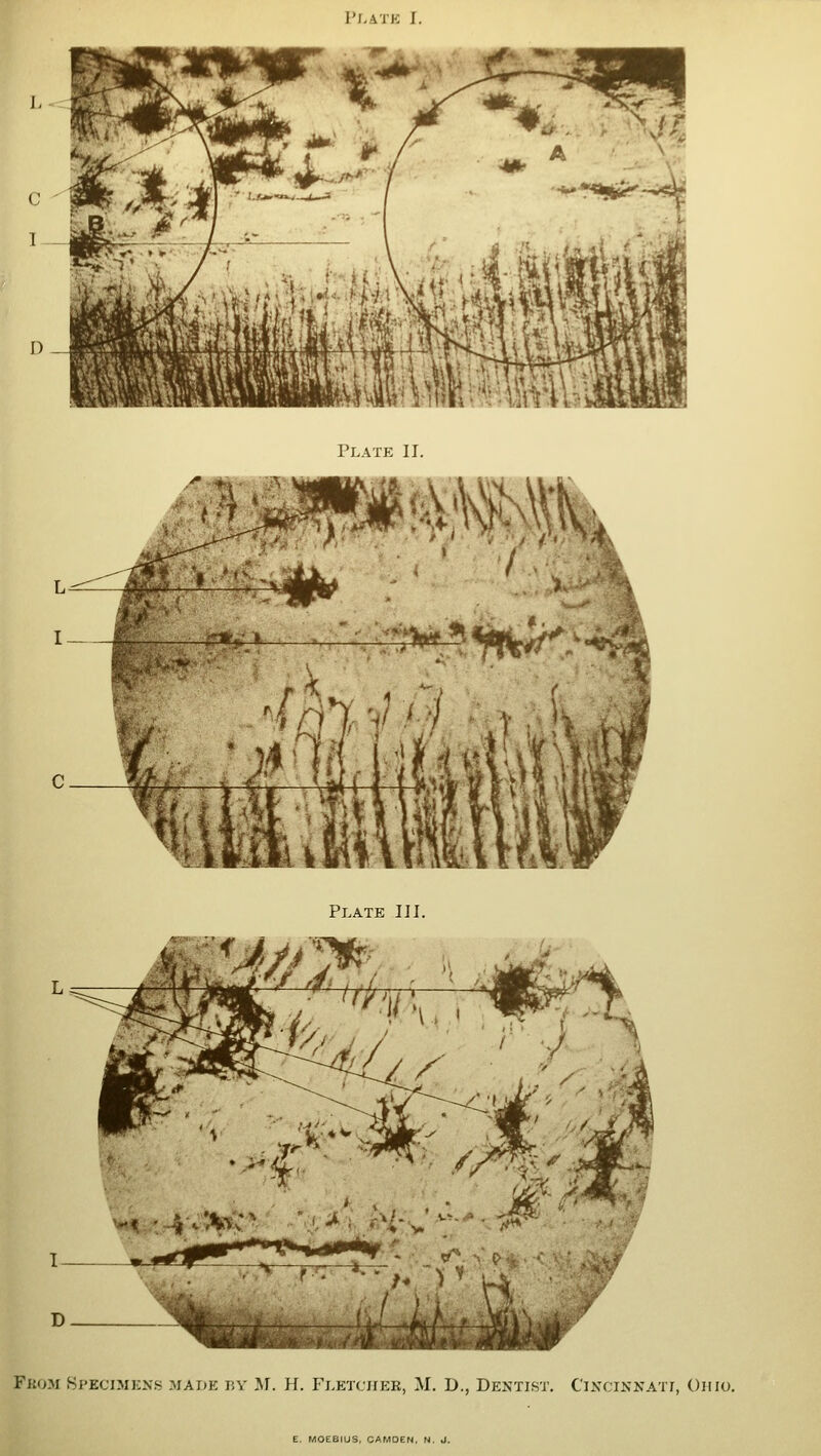 Plate II. Nf'*v,:> ,:•»» » Plate III. Fk(jm .Specimens mai>e by M. H. Fletcher, M. D., Dentist. Cincinnati, Ohio. E. MOEBfUS, CAMDEN, N. J.