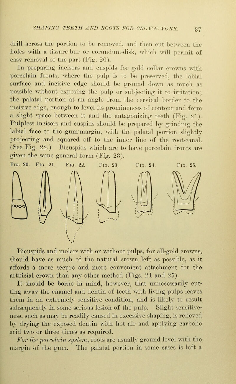 drill across the portion to be removed, and then cnt between the holes with a fissnre-bur or cornndum-disk, whieh will permit of easy removal of the part (Fig. 20). In preparing incisors and cuspids for gold collar crowns with porcelain fronts, where the pulp is to Ije ]jreserved, the labial surface and incisive edge should be ground down as much as possible without exposing the pulp or subjecting it to irritation; the palatal portion at an angle from the cervical border to the incisive edge, enough to level its prominences of contour and form a slight space between it and the antagonizing teeth (Fig. 21). Pulpless incisors and cuspids should be prepared by grinding the labial face to the gum^margin, Avith the palatal portion slightly projecting and squared off to the inner line of the root-canal. (See Fig. 22.) Bicuspids which are to have porcelain fronts are given the same general form (Fig. 23). Fig. 20. Ftg. 21. Fig. 22. Fig. 23. Fig. 24. Fig. 25. Bicuspids and molars with or without pulps, for all-gold crowns, should have as much of the natural crown left as possible, as it affords a more secure and more convenient attachment for the artificial crown than any other method (Figs. 24 and 25). It should be borne in mind, however, that unnecessarily cut- ting away the enamel and dentin of teeth ^^dth living pulps leaves them in an extremely sensitive condition, and is likely to result subsequently in some serious lesion of the pulp. Slight sensitive- ness, such as may be readily caused in excessive shaping, is relieved by drying the exposed dentin with hot air and applying carbolic acid two or three times as required. For the porcelain system, roots are usually ground level with the margin of the gum. The palatal portion in some cases is left a