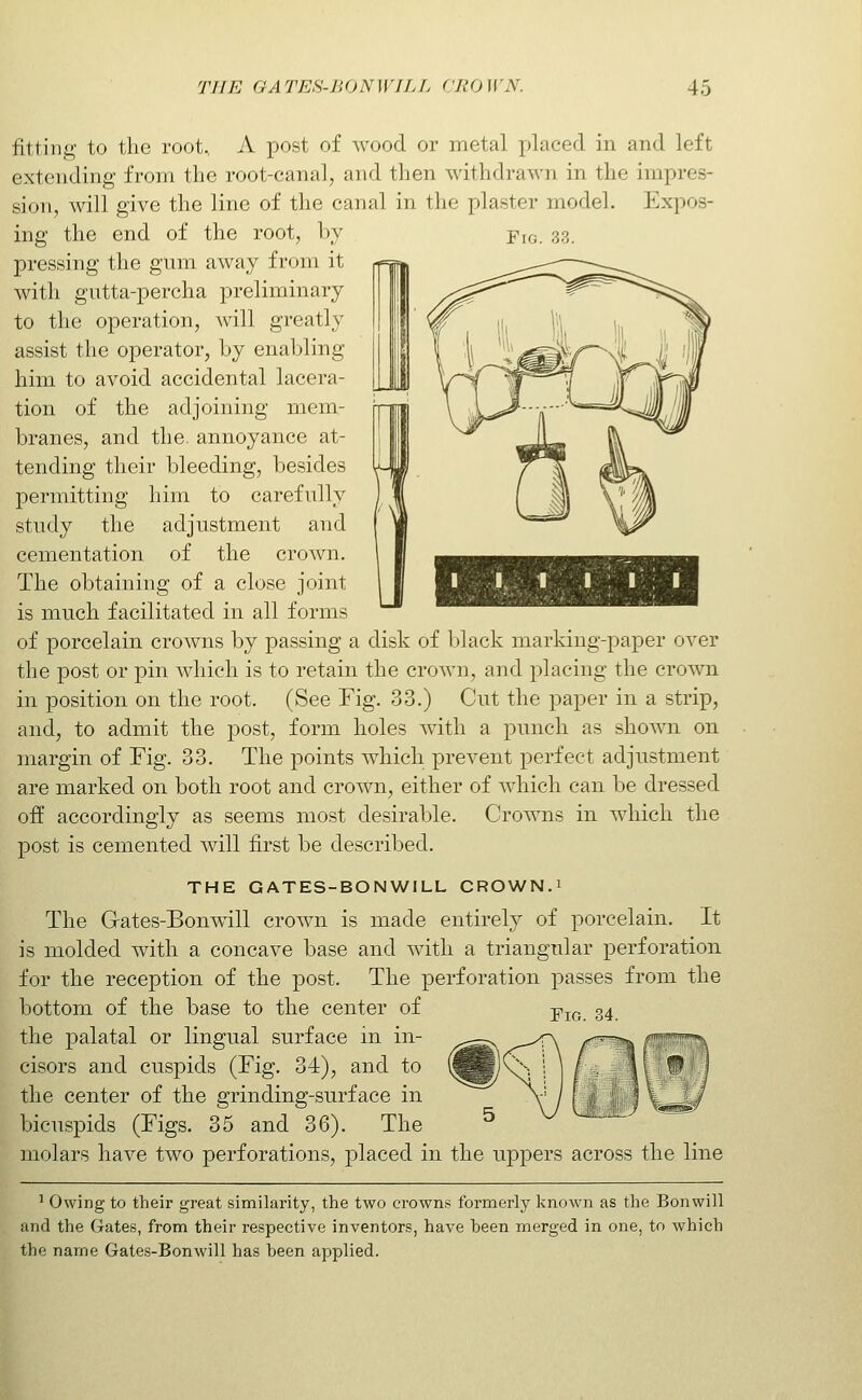 Fig. fitting to the root, A post of wood or metal placed in and left extending from the root-canal, and then withdrawn in the impres- sion, will give the line of the canal in the plaster model. Expos- ing the end of the root, by pressing the gum away from it with gutta-percha preliminary to the operation, will greatly assist the operator, by enabling him to avoid accidental lacera- tion of the adjoining mem- branes, and the annoyance at- tending their bleeding, besides permitting him to carefully study the adjustment and cementation of the crown. The obtaining of a close joint is much facilitated in all forms of porcelain crowns by passing a disk of 1)1 ack marking-paper over the post or pin which is to retain the crown, and placing the crown in position on the root. (See Fig. 33.) Cut the paper in a strip, and, to admit the post, form holes with a punch as shown on margin of Fig. 33. The points which prevent perfect adjustment are marked on both root and crown, either of which can be dressed off accordingly as seems most desirable. Crowns in which the post is cemented will first be described. THE GATES-BONWILL CROWN.i The Gates-Bonwill crown is made entirely of porcelain. It is molded with a concave base and with a triangular perforation for the reception of the post. The perforation passes from the bottom of the base to the center of the palatal or lingual surface in in- cisors and cuspids (Fig. 34), and to the center of the grinding-surface in bicuspids (Figs. 35 and 36). The molars have two perforations, placed in the uppers across the line ' Owing to their great similarity, the two crowns formerly known as the Bonwill and the Gates, from their respective inventors, have been merged in one, to which the name Gates-Bonwill has been applied. Fig. 34.