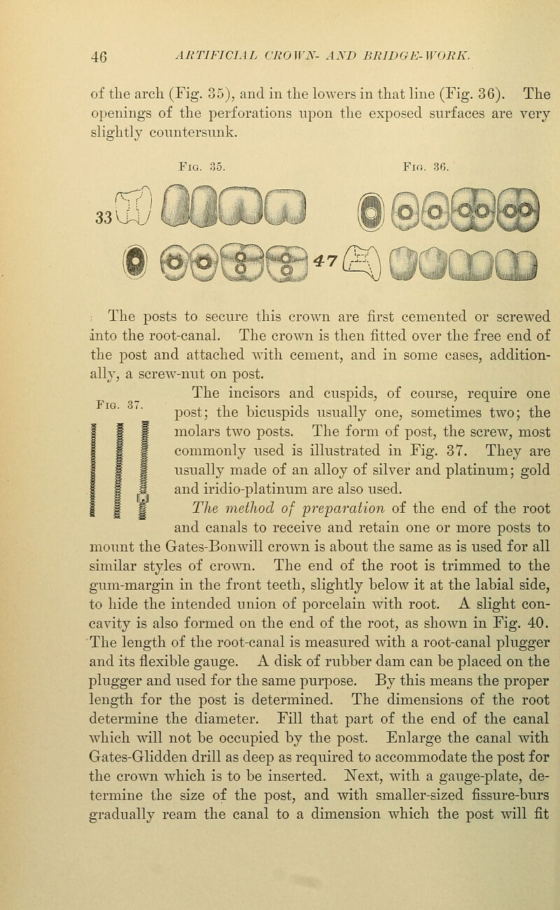 of the arch (Fig. 35), and in the lowers in that line (Fig. 36). The openings of the perforations upon the exposed surfaces are very slightly countersunk. Fig. 35. Fm. 36. ,.<=x r-^ ^rrr, /«-lr^, 47 _ jiii ; The posts to secure this crown are first cemented or screwed into the root-canal. The crown is then fitted over the free end of the post and attached with cement, and in some cases, addition- ally, a screw-nut on post. The incisors and cuspids, of course, require one post; the bicuspids usually one, sometimes two; the molars two posts. The form of post, the screw, most commonly used is illustrated in Fig. 37. They are usually made of an alloy of silver and platinum; gold and iridio-platinum are also used. The metliod of preparation of the end of the root and canals to receive and retain one or more posts to mount the Gates-Bonwill crown is about the same as is used for all similar styles of crown. The end of the root is trimmed to the gum-margin in the front teeth, slightly below it at the labial side, to hide the intended union of porcelain with root. A slight con- cavity is also formed on the end of the root, as shown in Fig. 40. The length of the root-canal is measured with a root-canal plugger and its flexible gauge. A disk of rubber dam can be placed on the plugger and used for the same purpose. By this means the proper length for the post is determined. The dimensions of the root determine the diameter. Fill that part of the end of the canal which will not be occupied by the post. Enlarge the canal with Gates-Glidden drill as deep as required to accommodate the post for the crown which is to be inserted. I^ext, with a gauge-plate, de- termine the size of the post, and with smaller-sized fissure-burs gradually ream the canal to a dimension which the post will fit