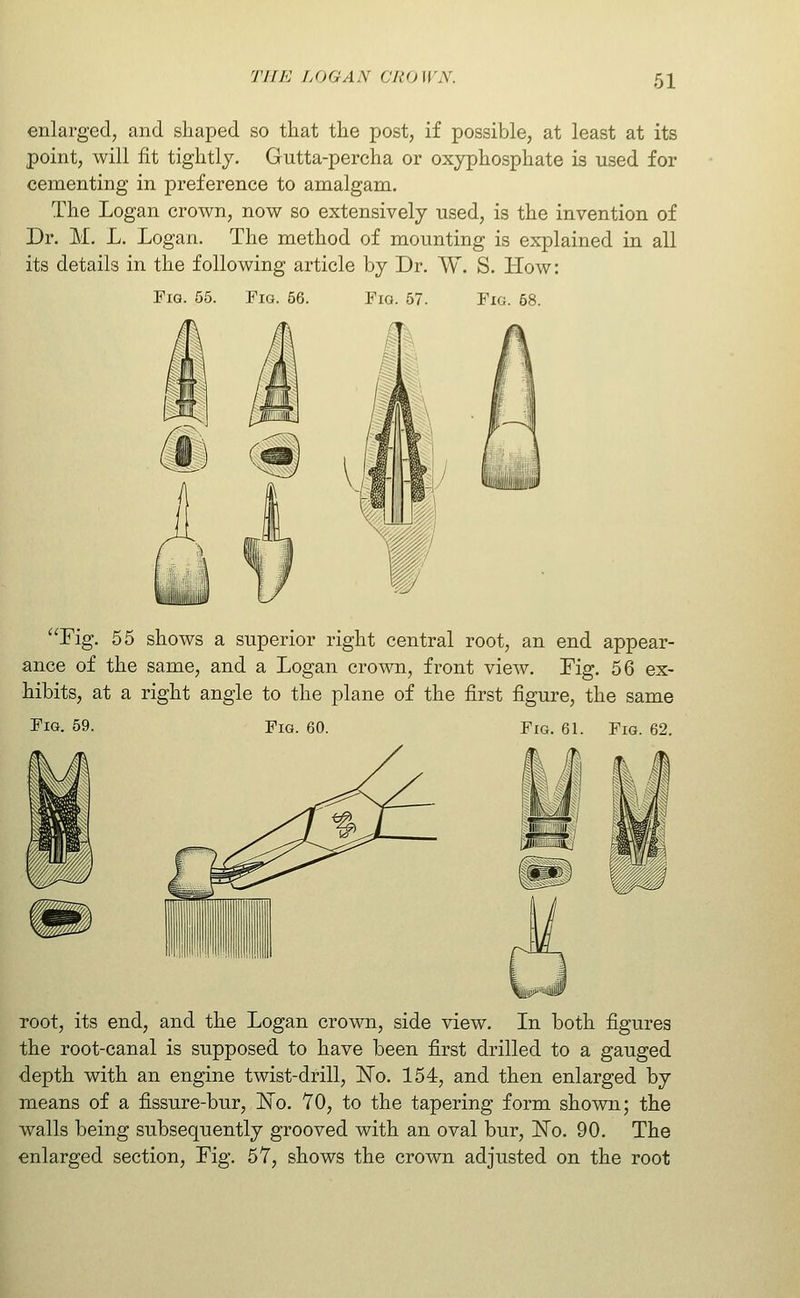 enlarged, and shaped so that the post, if possible, at least at its point, will fit tightly. Gutta-percha or oxyphosphate is used for cementing in preference to amalgam. The Logan crown, now so extensively used, is the invention of Dr. M. L. Logan. The method of mounting is explained in all its details in the following article by Dr. W. S. How: Fig. 55. Fm. 66. Fio. 57. Fig. 68. Fig. 55 shows a superior right central root, an end appear- ance of the same, and a Logan crown, front view. Fig. 56 ex- hibits, at a right angle to the plane of the first figure, the same Fig. 69. Fig. 60. Fig. 61. Fig. 62. root, its end, and the Logan crown, side view. In both figures the root-canal is supposed to have been first drilled to a gauged depth with an engine twist-drill, ISTo. 154, and then enlarged by means of a fissure-bur, ISTo. 70, to the tapering form shown; the walls being subsequently grooved with an oval bur, l^o. 90. The enlarged section, Fig. 5Y, shows the crown adjusted on the root