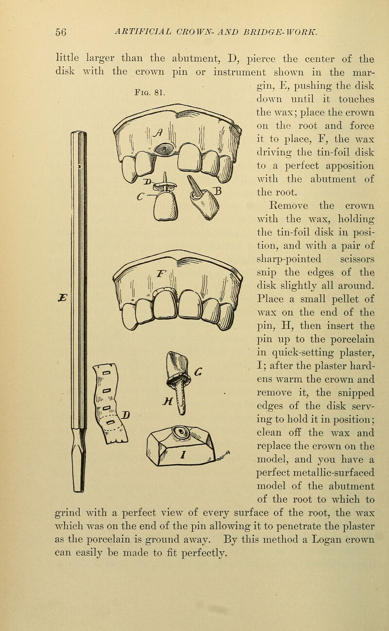 EiG. 81. little larger than the abutment, ~D, j)ierce the center of the disk with the crown pin or instrument shown in the mar- gin, E, pushing the disk down until it touches the wax; place the crown on the root and force it to place, F, the wax driving the tin-foil disk to a perfect apposition with the abutment of the root. Remove the crown with the wax, holding the tin-foil disk in posi- tion, and with a pair of sharp-pointed scissors snip the edges of the disk slightly all around. Place a small pellet of wax on the end of the pin, H, then insert the pin up to the porcelain in quick-setting plaster, I; after the plaster hard- ens warm the crown and remove it, the snipped edges of the disk serv- ing to hold it in position; clean off the wax and replace the crown on the model, and you have a perfect metallic-surfaced model of the abutment of the root to which to grind with a perfect view of every surface of the root, the wax which was on the end of the pin allowing it to penetrate the plaster as the porcelain is ground away. By this method a Logan crown can easily be made to fit perfectly.