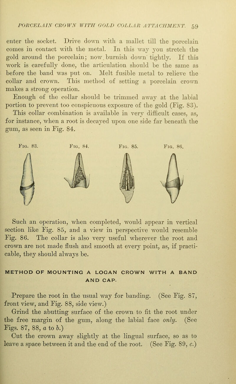 enter the socket. Drive clown with a mallet till the porcelain comes in contact with the metal. In this way you stretch the gold around the porcelain; now.burnish down' tightly. If this work is carefully done, the articulation should be the same as before the band was put on. Melt fusible metal to relieve the collar and crown. This method of setting a porcelain crown makes a strong operation. Enough of the collar should be trimmed away at the labial portion to prevent too conspicuous exposure of the gold (Fig. 83). This collar combination is available in very difficult cases, as, for instance, when a root is decayed upon one side far beneath the gum, as seen in Fig. 84. Fig. 83. Fig. 84. Fig. 85. Fig. 86. Such an operation, when completed, would appear in vertical section like Fig. 85, and a view in perspective would resemble Fig. 86. The collar is also very useful wherever the root and crovoi are not made flush and smooth at every point, as, if practi- cable, they should always be. METHOD OF MOUNTING A LOGAN CROWN WFTH A BAND AND CAP. Prepare the root in the usual way for banding. (See Fig. 87, front view, and Fig. 88, side view.) Grind the abutting surface of the crown to fit the root under the free margin of the gum, along the labial face only. (See Figs. 87, 88, a to I.) Cut the crown away slightly at the lingual surface, so as to leave a space between it and the end of the root. (See Fig. 89, c.)