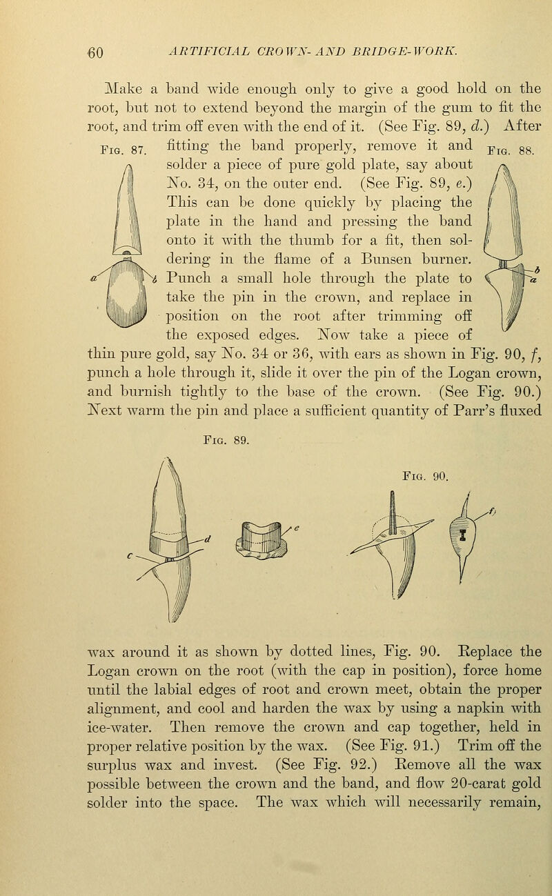 Make a band wide enough only to give a good hold on the root, but not to extend beyond the margin of the gum to fit the root, and trim off even with the end of it. (See Fig. 89, d.) After Fig 87 fitting the band properly, remove it and -^^^ solder a piece of pure gold plate, say about ISTo. 34, on the outer end. (See Fig. 89, e.) This can be done quickly by placing the plate in the hand and pressing the band onto it with the thumb for a fit, then sol- dering in the flame of a Bunsen burner. Punch a small hole through the plate to take the pin in the crown, and replace in position on the root after trimming off the exposed edges. ISTow take a piece of thin pure gold, say ISTo. 34 or 36, with ears as shown in Fig. 90, f, punch a hole through it, slide it over the pin of the Logan crown, and burnish tightly to the base of the crown. (See Fig. 90.) ]Next warm the pin and place a sufficient quantity of Parr's fluxed Fig. 89. Fig. 90. wax around it as shown by dotted lines. Fig. 90. Replace the Logan crown on the root (with the cap in position), force home until the labial edges of root and crown meet, obtain the proper alignment, and cool and harden the wax by using a napkin with ice-water. Then remove the crown and cap together, held in proper relative position by the wax. (See Fig. 91.) Trim off the surplus wax and invest. (See Fig. 92.) Remove all the wax possible between the crown and the band, and flow 20-carat gold solder into the space. The wax which will necessarily remain,