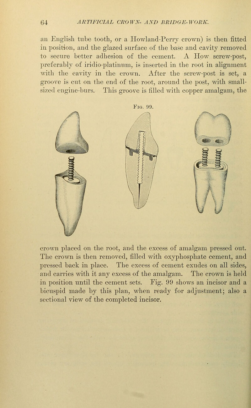 an English tube tooth, or a Ilowland-Perry crown) is then fitted in position, and the glazed surface of the base and cavity removed to secure better adhesion of the cement. A How screw-post, preferably of iridio-platinum, is inserted in the root in alignment with the cavity in the croAvn. After the screw-post is set, a groove is cut on the end of the root, around the post, with small- sized engine-burs. This groove is filled with copper amalgam, the Fig. 99. crown placed on the root, and the excess of amalgam pressed out. The crown is then removed, filled with oxyphosphate cement, and pressed back in place. The excess of cement exudes on all sides, and carries with it any excess of the amalgam. The crown is held in position until the cement sets. Fig. 99 shows an incisor and a bicuspid made by this plan, when ready for adjustment; also a sectional view of the completed incisor.