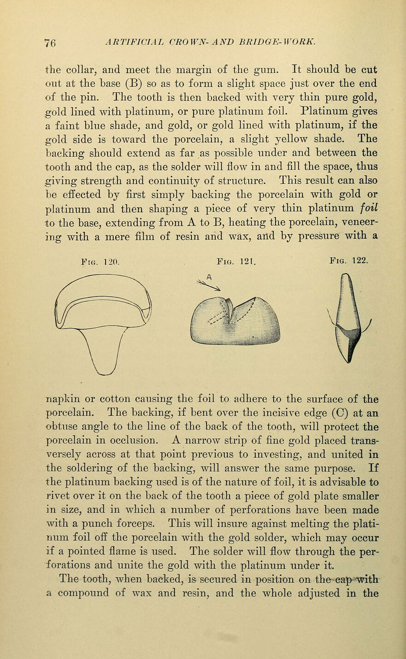 the collar, and meet the margin of the gum. It should be cut out at the base (B) so as to form a slight space just over the end of the pin. The tooth is then backed with very thin pure gold, gold lined with platinum, or pure platinum foil. Platinum gives a faint blue shade, and gold, or gold lined with platinum, if the gold side is toward the porcelain, a slight yellow shade. The backing should extend as far as possible under and between the tooth and the cap, as the solder will flow in and fill the space, thus giving strength and continuity of structure. This result can also be effected by first simply backing the porcelain with gold or platinum and then shaping a piece of very thin platinum foil to the base, extending from A to B, heating the porcelain, veneer- ing with a mere film of resin and wax, and by pressure with a Fig. 120. , Fm. 121. Fig. 122. napkin or cotton causing the foil to adhere to the surface of the porcelain. The backing, if bent over the incisive edge (C) at an obtuse angle to the line of the back of the tooth, will protect the porcelain in occlusion. A narrow strip of fine gold placed trans- versely across at that point previous to investing, and united in the soldering of the backing, will answer the same purpose. If the platinum backing used is of the nature of foil, it is advisable to rivet over it on the back of the tooth a piece of gold plate smaller in size, and in which a number of perforations have been made with a punch forceps. This will insure against melting the plati- num foil off the porcelain with the gold solder, which may occur if a pointed flame is used. The solder will flow through the per- forations and unite the gold with the platinum under it. The tooth, when backed, is secured in position on the •eap-'With a compound of wax and resin, and the whole adjusted in the