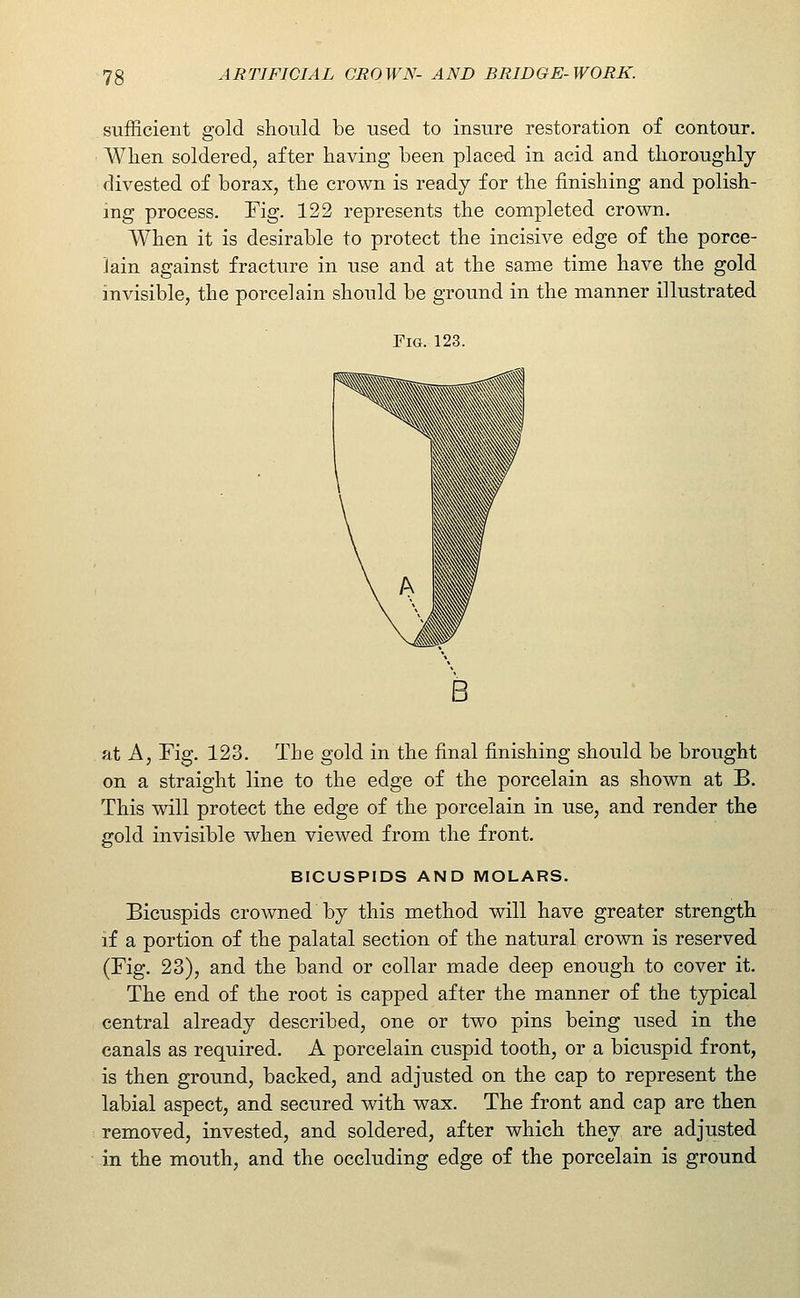 sufficient gold should be used to insure restoration of contour. When soldered, after having been placed in acid and thoroughly divested of borax, the crown is ready for the finishing and polish- mg process. Fig. 122 represents the completed crown. When it is desirable to protect the incisive edge of the porce- lain against fracture in use and at the same time have the gold invisible, the porcelain should be ground in the manner illustrated Fig. 123. A\ ^^ \^ at A, Fig. 123, The gold in the final finishing should be brought on a straight line to the edge of the porcelain as shown at B. This will protect the edge of the porcelain in use, and render the gold invisible when viewed from the front. BICUSPIDS AND MOLARS. Bicuspids crowned by this method will have greater strength if a portion of the palatal section of the natural crown is reserved (Fig. 23), and the band or collar made deep enough to cover it. The end of the root is capped after the manner of the typical central already described, one or two pins being used in the canals as required. A porcelain cuspid tooth, or a bicuspid front, is then ground, backed, and adjusted on the cap to represent the labial aspect, and secured with wax. The front and cap are then removed, invested, and soldered, after which they are adjusted in the mouth, and the occluding edge of the porcelain is ground