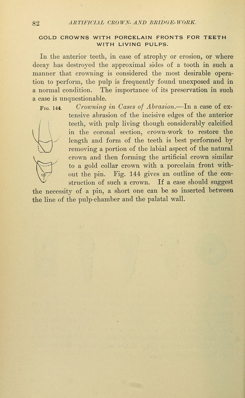 GOLD CROWNS WITH PORCELAIN FRONTS FOR TEETH WITH LIVING PULPS. In the anterior teeth, in case of atrophy or erosion, or where decay has destroyed the approximal sides of a tooth in such a manner that crowning is considered the most desirable opera- tion to perform, the pulp is frequently found unexposed and in a normal condition. The importance of its preservation in such a case is unquestionable. Fig. 144. Crowning in Cases of Abrasion.—In a case of ex- tensive abrasion of the incisive edges of the anterior teeth, with pulp living though considerably calcified in the coronal section, crown-work to restore the length and form of the teeth is best performed by removing a portion of the labial aspect of the natural crown and then forming the artificial crown similar to a gold collar crown with a porcelain front with- out the pin. Fig. 144 gives an outline of the con- struction of such a crown. If a case should suggest the necessity of a pin, a short one can be so inserted between the line of the pulp-chamber and the palatal wall.