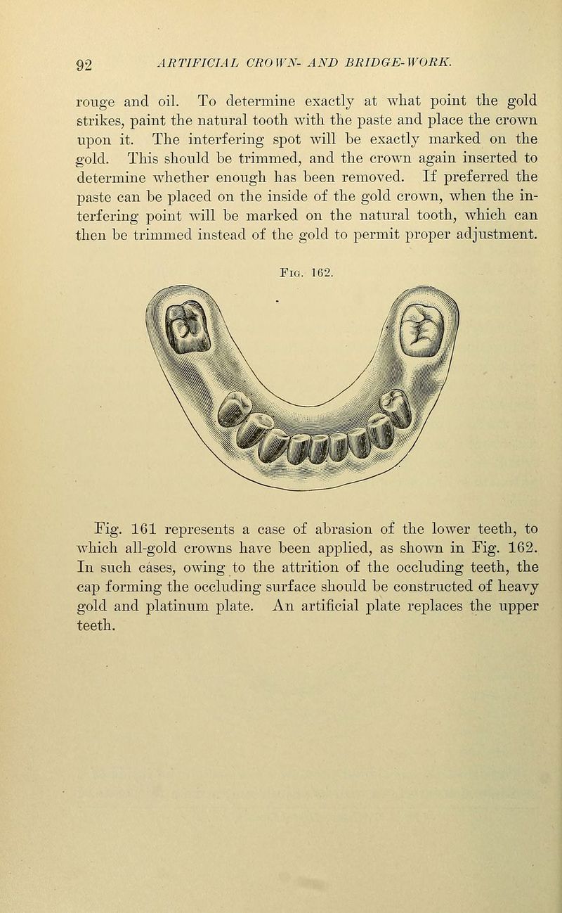 rouge and oil. To determine exactly at wliat point the gold strikes, paint the natural tooth with the paste and place the crown upon it. The interfering spot will be exactly marked on the gold. This should be trimmed, and the crown again inserted to determine whether enough has been removed. If preferred the paste can be placed on the inside of the gold crown, when the in- terfering point will be marked on the natural tooth, which can then be trimmed instead of the gold to permit proper adjustment. Pig. 162. Fig. 161 represents a case of abrasion of the lower teeth, to Avhich all-gold crowns have been applied, as shown in Fig. 162. In such cases, owing to the attrition of the occluding teeth, the cap forming the occluding surface should be constructed of heavy gold and platinum plate. An artificial plate replaces the upper teeth.
