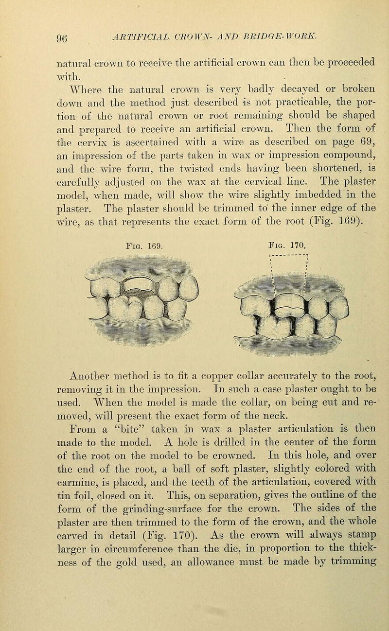 natural crown to receive the artificial crown can then be proceeded with. Where the natural crown is very badly decayed or broken down and the method just described is not practicable, the por- tion of the natural crown or root remaining should be shaped and prepared to receive an artificial crown. Then the form of the cervix is ascertained with a wire as described on page 69, an impression of the parts taken in wax or impression compound, and the wire form, the twisted ends having been shortened, is carefully adjusted on the wax at the cervical line. The plaster model, when made, will show the wire slightly imbedded in the plaster. The plaster should be trimmed to the inner edge of the wire, as that represents the exact form of the root (Fig. 169). Tig. 169. Fig. 170. Another method is to fit a copper collar accurately to the root, removing it in the impression. In such a case plaster ought to be used. When the model is made the collar, on being cut and re- moved, will present the exact form of the neck. From a bite taken in wax a plaster articulation is then made to the model. A hole is drilled in the center of the form of the root on the model to be crowned. In this hole, and over the end of the root, a ball of soft plaster, slightly colored with carmine, is placed, and the teeth of the articulation, covered with tin foil, closed on it. This, on separation, gives the outline of the form of the grinding-surface for the crown. The sides of the plaster are then trimmed to the form of the crown, and the whole carved in detail (Fig. 170). As the crown will always stamp larger in circumference than the die, in proportion to the thick- ness of the gold used, an allowance must be made by trimming