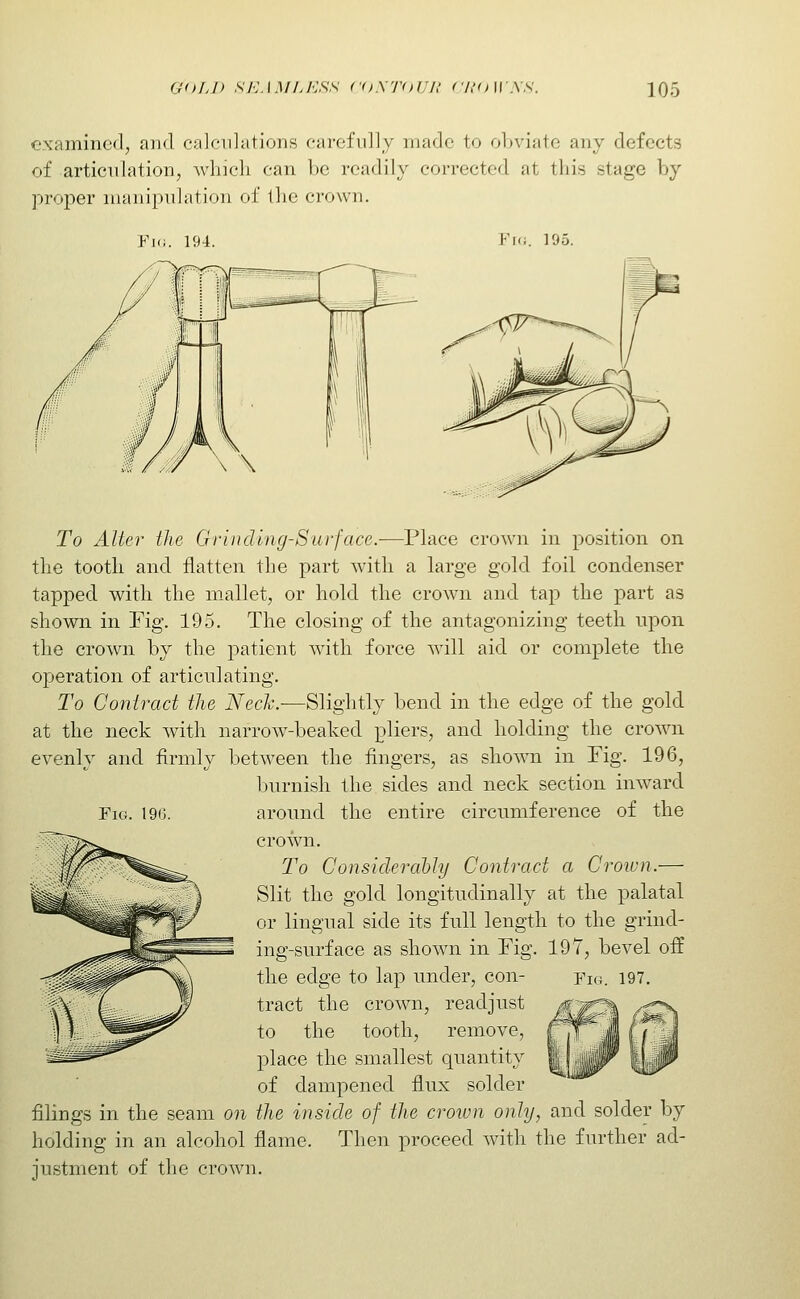 examined, and calculations carefully made to ol)viate any defects of articulation, which can be readily corrected at this stage by proper manipulation of the crown. Fk;. 194. Fn;. 195. To Alter the Grin ding-Surface.—Place crown in position on the tooth and flatten the part with a large gold foil condenser tapped with the mallet, or hold the crown and tap the part as shown in Fig. 195. The closing of the antagonizing teeth upon the crown by the patient with force will aid or complete the operation of articulating. To Contract the Neck.—Slightly bend in the edge of the gold at the neck with narrow-beaked pliers, and holding the crown evenly and firmly between the fingers, as shown in Fig. 196, burnish the sides and neck section inward Fig. 196. around the entire circumference of the crown. To Consiclerahly Contract a Croivn.— Slit the gold longitudinally at the palatal or lingual side its full length to the grind- ing-surface as shown in Fig. 197, bevel off the edge to lap under, con- fic4. i97. tract the crown, readjust to the tooth, remove, place the smallest quantity of dampened flux solder filings in the seam on the inside of the crown only, and solder by holding in an alcohol flame. Then proceed with the further ad- justment of the crown.