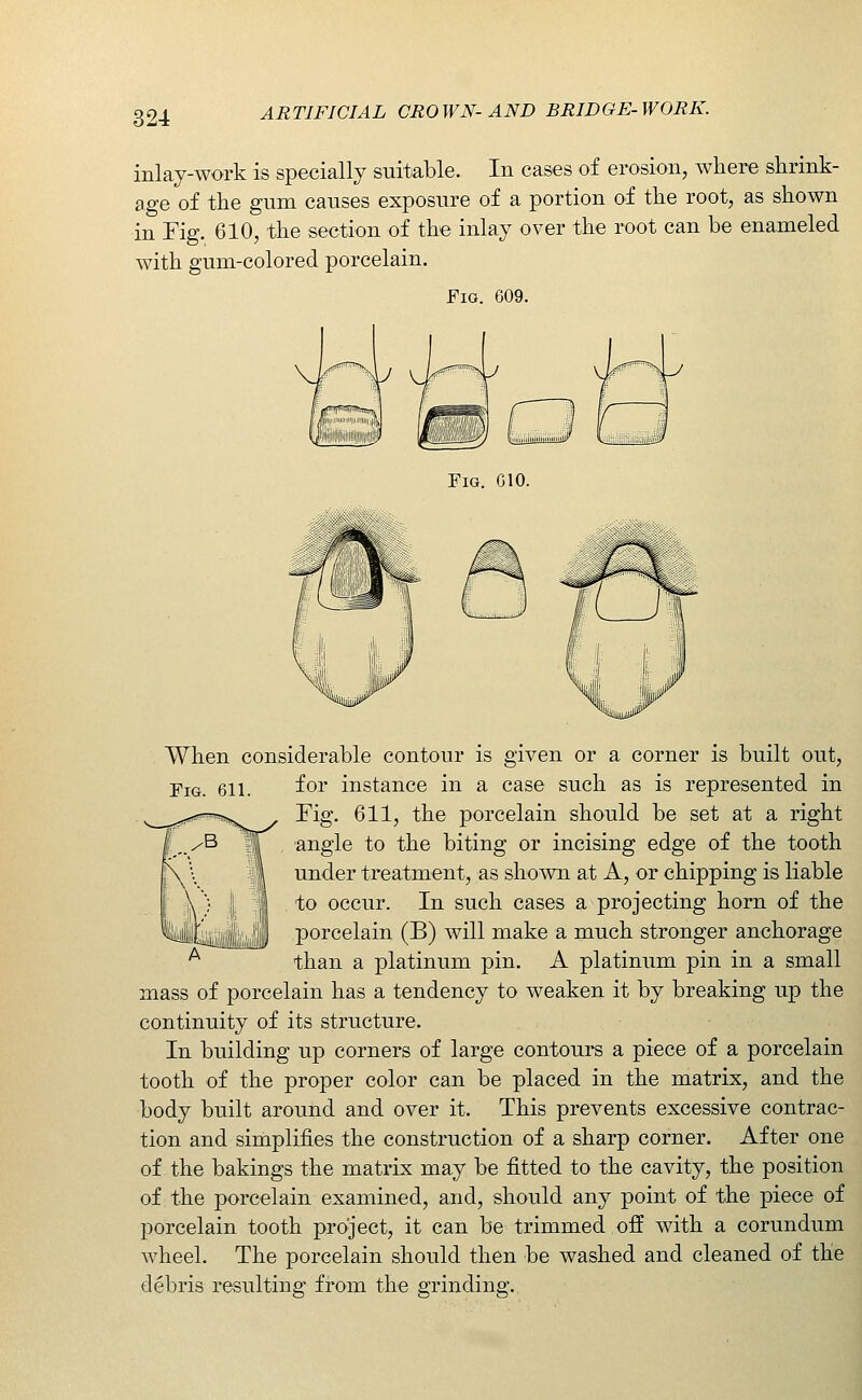 inlay-work is specially suitable. In cases of erosion, where shrink- age of the gnm causes exposure of a portion of the root, as shown in Fig. 610, the section of the inlay over the root can be enameled with gum-colored porcelain. Fig. 609. Fig. GIO. When considerable contour is given or a corner is built out. Fig. 611. for instance in a case such as is represented in Fig. 611, the porcelain should be set at a right angle to the biting or incising edge of the tooth under treatment, as shown at A, or chipping is liable to occur. In such cases a projecting horn of the porcelain (B) will make a much stronger anchorage than a platinum pin. A platinum pin in a small mass of porcelain has a tendency to weaken it by breaking up the continuity of its structure. In building up corners of large contours a piece of a porcelain tooth of the proper color can be placed in the matrix, and the body built arouiid and over it. This prevents excessive contrac- tion and simplifies the construction of a sharp corner. After one of the bakings the matrix may be fitted to the cavity, the position of the porcelain examined, and, should any point of the piece of porcelain tooth project, it can be trimmed off with a corundum wheel. The porcelain should then be washed and cleaned of the debris resulting from the grinding.