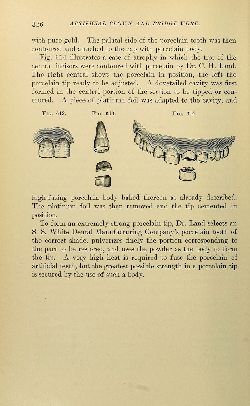 with pure gold. The palatal side of the porcelain tooth was then contoured and attached to the cap with porcelain body. Fig. 614 illustrates a case of atrophy in which the tips of the central incisors were contoured with porcelain by Dr. G. H. Land. The right central shows the porcelain in position, the left the porcelain tip ready to be adjusted. A dovetailed cavity was first formed in the central portion of the section to be tipped or con- toured. A piece of platinum foil was adapted to the cavity, and Fig. 612. Fig. 613. Fig. 614. high-fusing porcelain body baked thereon as already described. The platinum foil was then removed and the tip cemented in position. To form an extremely strong porcelain tip, Dr. Land selects an S. S. White Dental Manufacturing Company's porcelain tooth of the correct shade, pulverizes finely the portion corresponding to the part to be restored, and uses the powder as the body to form the tip. A very high heat is required to fuse the porcelain of artificial teeth, but the greatest possible strength in a porcelain tip is secured by the use of such a body.
