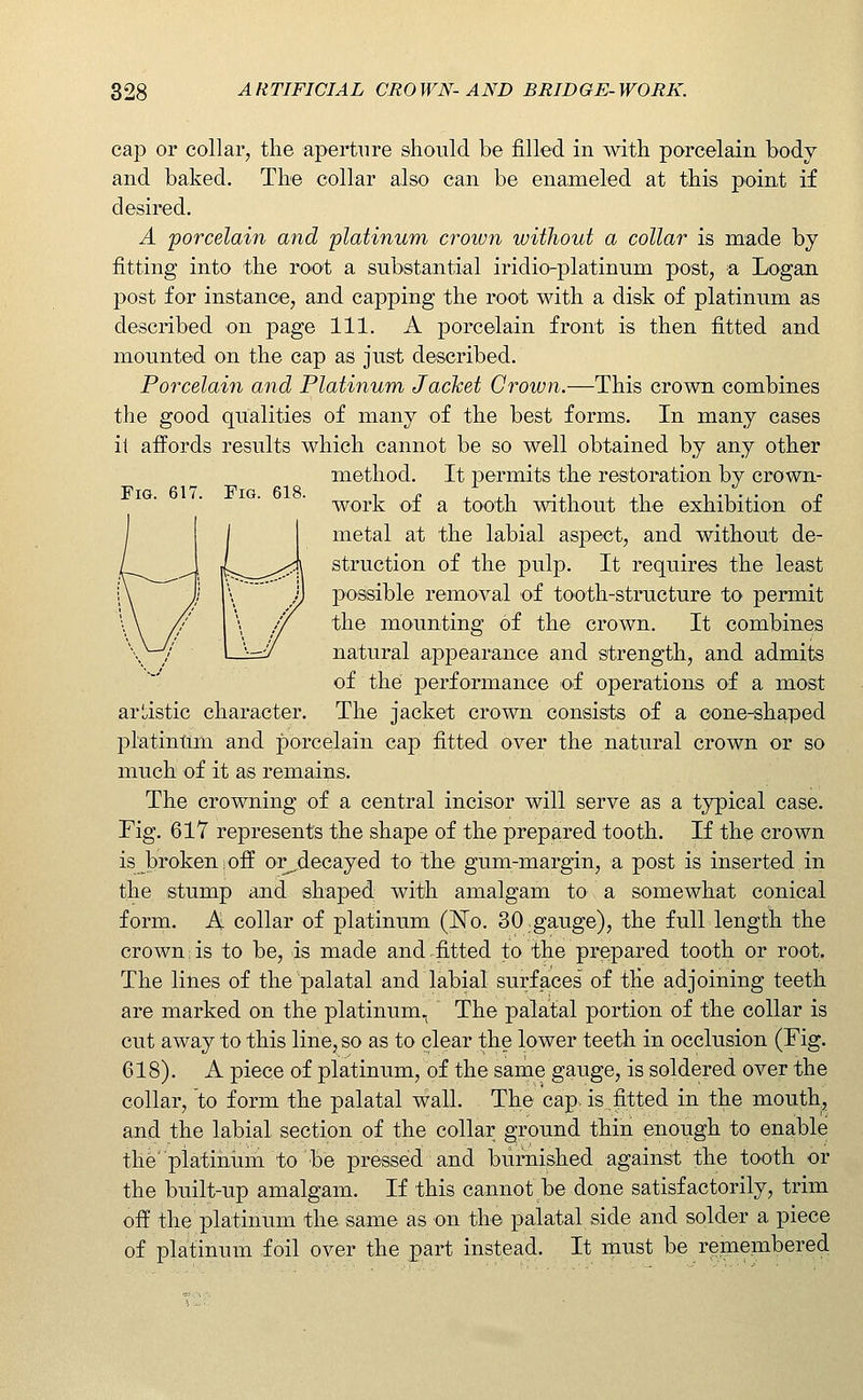 cap or collar, the aperture should be filled in with porcelain body and baked. The collar also can be enameled at this point if desired. A 'porcelain and platinum croiun without a collar is made by fitting into the root a substantial iridio-platinum post, a Logan post for instance, and capping the root with a disk of platinum as described on page 111. A porcelain front is then fitted and mounted on the cap as just described. Porcelain and Platinum JacJcet Crown.—This crown combines the good qualities of many of the best forms. In many cases it affords results which cannot be so well obtained by any other method. It permits the restoration by crown- work of a tooth without the exhibition of Ul metal at the labial aspect, and without de- L__^-\ struction of the pulp. It requires the least ' \ J possible removal of tooth-structure to permit \ ,y the mounting of the crown. It combines \ / 1. }—-y natural appearance and strength, and admits of the performance of operations of a most arl,istic character. The jacket crown consists of a oone-shaped platintim and porcelain cap fitted over the natural crown or so much of it as remains. The crowning of a central incisor will serve as a typical case. Fig. 617 represents the shape of the prepared tooth. If the crown is broken;off or^decayed to the gum-margin, a post is inserted in the stump and shaped with amalgam to a somewhat conical form. A collar of platinum (No. 30 gauge), the full length the crown is to be, is made and .fitted to the prepared tooth or root. The lines of the palatal and labial surfaces of the adjoining teeth are marked on the platinum.j The palatal portion of the collar is cut away to this line, so as to clear the lower teeth in occlusion (Fig. 618). A piece of platinum, of the same gauge, is soldered over the collar, to form the palatal wall. The cap. is fitted in the mouth., and the labial section of the collar ground thin enough to ena.ble the'piatihum to be pressed and burnished against the tooth or the built-up amalgam. If this cannot be done satisfactorily, trim off the platinum the same as on the palatal side and solder a piece of platinum foil over the part instead. It must be remembered