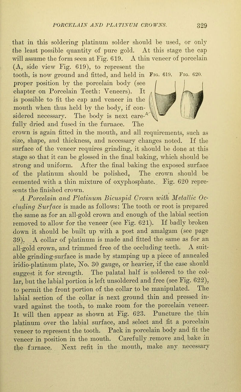 that in this soldering platinum solder should be used, or only the least possible quantity of pure gold. At this stage the cap will assume the form seen at Fig. 619. A thin veneer of porcelain (A, side view Fig. 619), to represent the tooth, is now ground and fitted, and held in Fig. 619, Fig. 620. proper position by the porcelain body (see chapter on Porcelain Teeth: Veneers). It a is possible to fit the cap and veneer in the ; ■ mouth when thus held by the body, if con- sidered necessary. The body is next care-^ \ fully dried and fused in the furnace. The crown is again fitted in the mouth, and all requirements, such as size, shape, and thickness, and necessary changes noted. If the surface of the veneer requires grinding, it should be done at this stage so that it can be glossed in the final baking, which should be strong and uniform. After the final baking the exposed surface of the platinum should be polished. The crown should be cemented with a thin mixture of oxyphosphate.. Fig. 620 repre- sents the finished crown. A Porcelain and Platinum Bicuspid Crown with Metallic Oc- cluding Surface is made as follows: The tooth or root is prepared the same as for an all-gold crown and enough of the labial section removed to allow for the veneer (see Fig. 621). If badly broken down it should be built up with a post and amalgam (see page 39). A collar of platinum is made and fitted the same as for an all-gold crown, and trimmed free of the occluding teeth. A suit- able grinding-surface is made by stamping up a piece of annealed iridio-platinum plate, iSTo. 30 gauge, or heavier, if the case should suggest it for strength. The palatal balf is soldered to the col- lar, but the labial portion is left unsoldered and free (see Fig. 622), to permit the front portion of the collar to be manipulated. The labial section of the collar is next ground thin and pressed in- ward against the tooth, to make room for the porcelain veneer. It will then appear as shown at Fig. 623. Puncture the thin platinum over the labial surface, and select and fit a porcelain veneer to represent the tooth. Pack in porcelain body and fit the veneer in position in the mouth. Carefully remove and bake in the furnace. IvText refit in the mouth, make any necessary