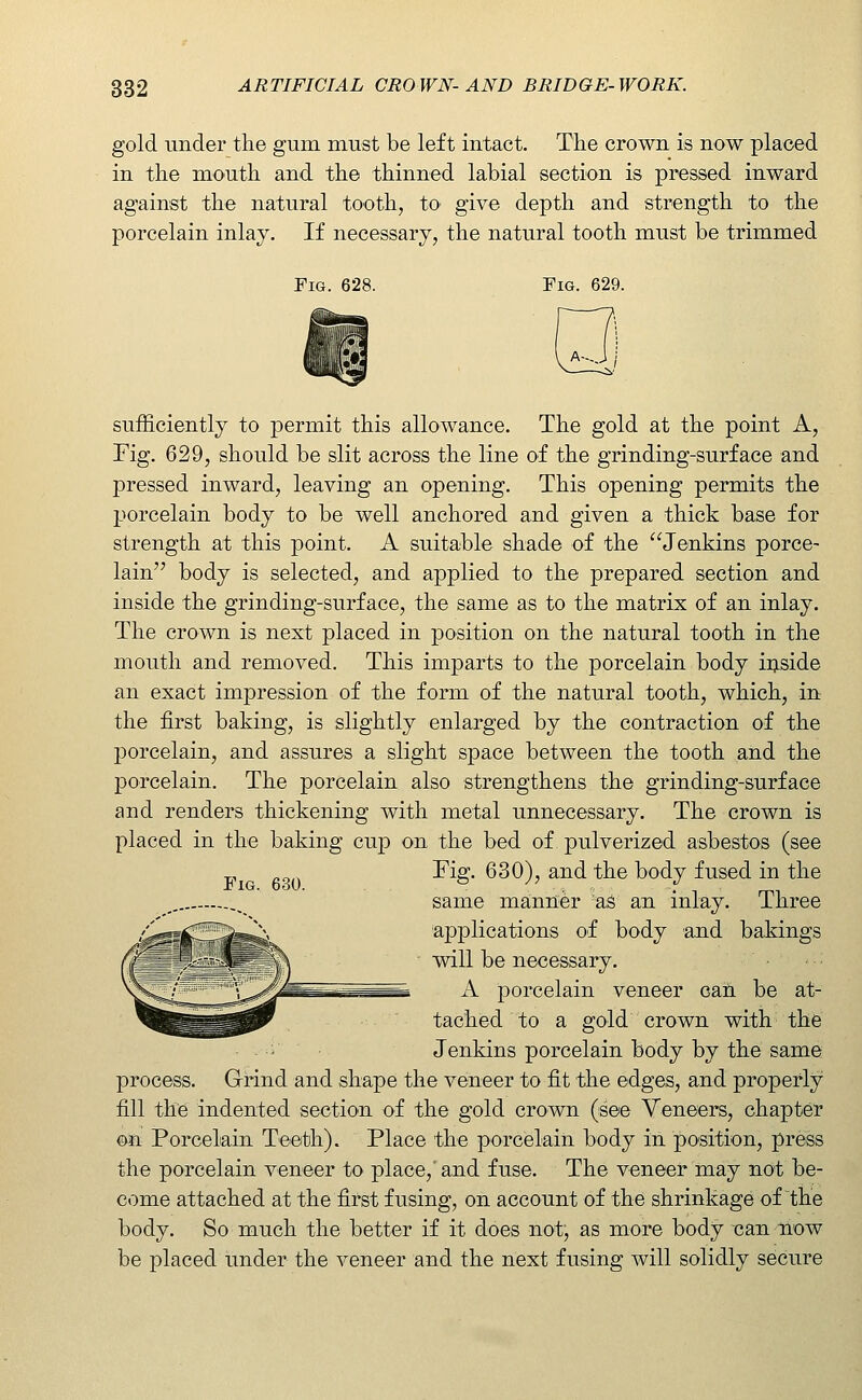 gold under the gum must be left intact. The crown is now placed in the mouth and the thinned labial section is pressed inward against the natural tooth, to give depth and strength to the porcelain inlay. If necessary, the natural tooth must be trimmed Fig. 628. Tig. 629. sufficiently to permit this allowance. The gold at the point A, Fig. 629, should be slit across the line of the grinding-surface and pressed inward, leaving an opening. This opening permits the porcelain body to be well anchored and given a thick base for strength at this point. A suitable shade of the Jenkins porce- lain body is selected, and applied to the prepared section and inside the grinding-surface, the same as to the matrix of an inlay. The crown is next placed in position on the natural tooth in the mouth and removed. This imparts to the porcelain body iijside an exact impression of the form of the natural tooth, which, in the first baking, is slightly enlarged by the contraction of the porcelain, and assures a slight space between the tooth and the porcelain. The porcelain also strengthens the grinding-surface and renders thickening with metal unnecessary. The crown is placed in the baking cup on the bed of pulverized asbestos (see „ rig. 630), and the body fused in the _ ,^ same manner aS an inlay. Three applications of body and bakings will be necessary. A porcelain veneer caii be at- tached to a gold crown with the Jenkins porcelain body by the same process. Grind and shape the veneer to fit the edges, and properly fill the indented section of the gold crown (see Veneers, chapter on Porcelain Teeth). Place the porcelain body in position, press the porcelain veneer to place,' and fuse. The veneer may not be- come attached at the first fusing, on account of the shrinkage of the body. So much the better if it does not, as more body can now be placed under the veneer and the next fusing will solidly secure
