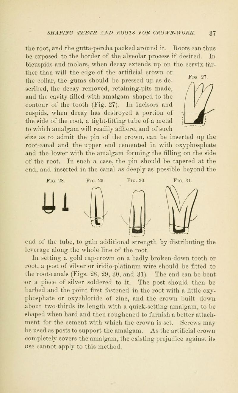 Fio 27. the root, and the gutta-percha packed around it. Roots can thus be exposed to the border of the alveolar process if desired. In bicuspids and molars, when decay extends up on the cervix far- ther than will the edge of the artificial crown or the collar, the gums should be pressed up as de- scribed, the decay removed, retaining-pits made, and the cavity filled with amalgam shaped to the contour of the tooth (Fig. 27). In incisors and cuspids, when decay has destroyed a portion of the side of the root, a tight-fitting tube of a metal to which amalgam will readilv adhere, and of such size as to admit the pin of the crown, can be inserted up the root-canal and the upper end cemented in with oxyphosphate and the lower with the amalgam forming the filling on the side of the root. In such a case, the pin should be tapered at the end, and inserted in the canal as deeply as possible beyond the Fig. 28. Ul Fig. 29. Fig. 30. m Fig. 31. end of the tube, to gain additional strength by distributing the leverage along the whole line of the root. In setting a gold cap-crown on a badly broken-down tooth or root, a post of silver or iridio-platinum wire should be fitted to the root-canals (Figs. 28, 29, 30, and 31). The end can be bent or a piece of silver soldered to it. The post should then be barbed and the point first fastened in the root with a little oxy- phosphate or oxychloride of zinc, and the crown built down about two-thirds its length with a quick-setting amalgam, to be shaped when hard and then roughened to furnish a better attach- ment for the cement with which the crown is set. Screws may be used as posts to support the amalgam. As the artificial crown completely covers the amalgam, the existing prejudice against its use cannot apply to this method.