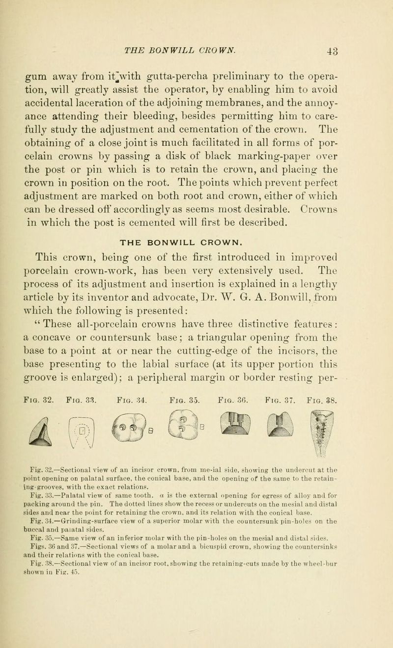 gum away from it'with gutta-percha preliminary to the opera- tion, will greatly assist the operator, by enabling him to avoid accidental laceration of the adjoining membranes, and the annoy- ance attending their bleeding, besides permitting him to care- fully study the adjustment and cementation of the crown. The obtaining of a close joint is much facilitated in all forms of por- celain crowns by passing a disk of black marking-paper over the post or pin which is to retain the crown, and placing the crown in position on the root. The points which prevent perfect adjustment are marked on both root and crown, either of which can be dressed oft' accordingly as seems most desirable. Crowns in which the post is cemented will first be described. THE BONWILL CROWN. This crown, being one of the first introduced in improved porcelain crown-work, has been very extensively used. The process of its adjustment and insertion is explained in a lengthy article by its inventor and advocate, Dr. W. G. A. Bonwill, from which the following is presented:  These all-porcelain crowns have three distinctive features: a concave or countersunk base; a triangular opening from the base to a point at or near the cutting-edge of the incisors, the base presenting to the labial surface (at its upper portion this groove is enlarged); a peripheral margin or border resting per- Fig. 32.—Sectional view of an incisor crown, from me-ial side, showing the undercut at the point opening od palatal surface, the conical base, and the opening of the same to the retain- ing-grooves, with the exact relations. Fig. 33.—Palatal view of same tooth, a is the external opening for ogress of alloy ami for packing around the pin. The dotted lines show the recess or undercuts on the mesial and distal sides and near the point for retaining the crown, and its relation with the conical base Fig. 34.—Grinding-surface view of a superior molar with the countersunk pin-hole- on the buccal and palatal sides. Fig. 35.—Same view of an inferior molar with the pin-holes on the mesial ami distal sides. Figs. 36 and 37.—Sectional views of a molar and a bicuspid crown, showing the countersink- and their relations with the conical base. Fig. 38.—Sectional view of an incisor root, showing the retaining-cuts made by the wheel-bur shown in Fig. 45.