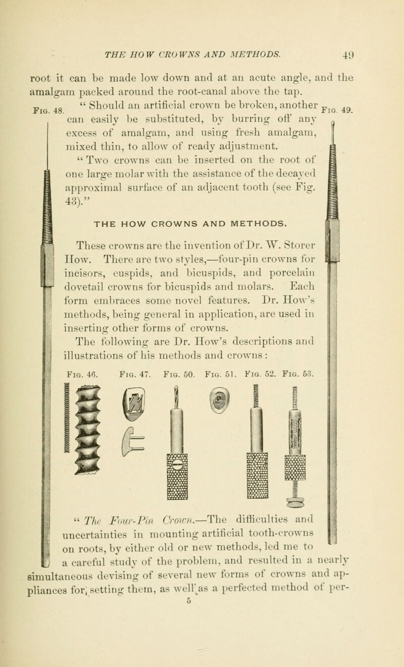 Fig. 48. root it can be made low down and at an acute angle, and the amalgam packed around the root-canal above the tap. ; Should an artificial crown be broken, another F 49 can easily be substituted, by burring off any excess of amalgam, and using fresh amalgam, mixed thin, to allow of ready adjustment. Two crowns can be inserted on the root of one large molar with the assistance of the decayed approximal surface of an adjacent tooth (see Fig. 43). m THE HOW CROWNS AND METHODS. These crowns are the invention of Dr. W. Storer How. There are two styles,—four-pin crowns for incisors, cuspids, and bicuspids, and porcelain dovetail crowns for bicuspids and molars. Each form embraces some novel features. Dr. How's methods, being general in application, are used in inserting other forms of crowns. The following are Dr. How's descriptions and illustrations of his methods and crowns : Fig. 46. Fig. 47. Fig. 50. Fig. 51. Fig. 52. Fig. 53. The Four-Pin Grown.—The difficulties and uncertainties in mounting artificial tooth-crowns on roots, by either old or new methods, led me to a careful study of the problem, and resulted in a nearly simultaneous devising of several new forms of crowns and ap- pliances for, setting them, as well'as a perfected method of per- 5