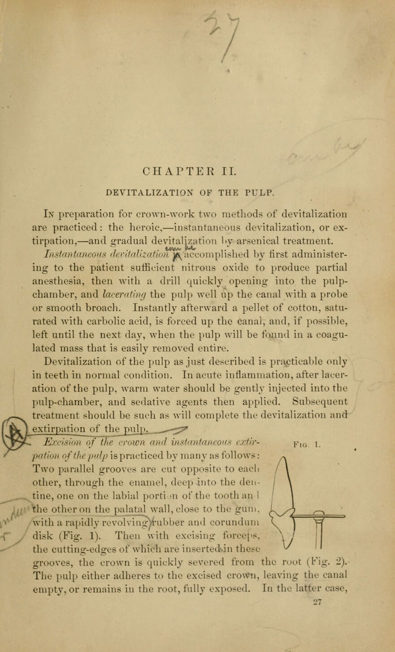 CHAPTER II. DEVITALIZATION OF THE PULP. In preparation for crown-work two methods of devitalization are practiced: the heroic,—instantaneous devitalization, or ex- tirpation,—and gradual devitalization !>v arsenical treatment. Instantaneous devitalization m'accomplished by first administer- ing to the patient sufficient nitrous oxide to produce partial anesthesia, then with a drill quickly opening into the pulp- chamber, and Ulcerating the pulp well up the canal with a probe or smooth broach. Instantly afterward a pellet of cotton, satu- rated with carbolic acid, is forced up the canal, and, if possible, left until the next day, when the pulp will be found in a coagu- lated mass that is easily removed entire. Devitalization of the pulp as just described is practicable only in teeth in normal condition. In acute inflammation, after lacer- ation of the pulp, warm water should be gently injected into the pulp-chamber, and sedative agents then applied. Subsequent treatment should be such as will complete the devitalization and extirpation of the pulp. __^--^ Excision of ike crown and instantaneous extir- pIO i. pation ofthcpulp ispracticed by many as follows: Two parallel grooves are cut opposite to each other, through the enamel, deep into the den- tine, one on the labial porti >n of the tooth an ! ln\'\he other on the palatal wall, close to the gum. with a rapidly revolving 'rubber and corundum disk (Fig. 1). Then with excising forceps, the cuttinoc-edsres of which are inserted in these grooves, the crown is quickly severed from the root (Fig. 2). The pulp either adheres to the excised crown, leaving the canal empty, or remains in the root, fully exposed. In the latter case,