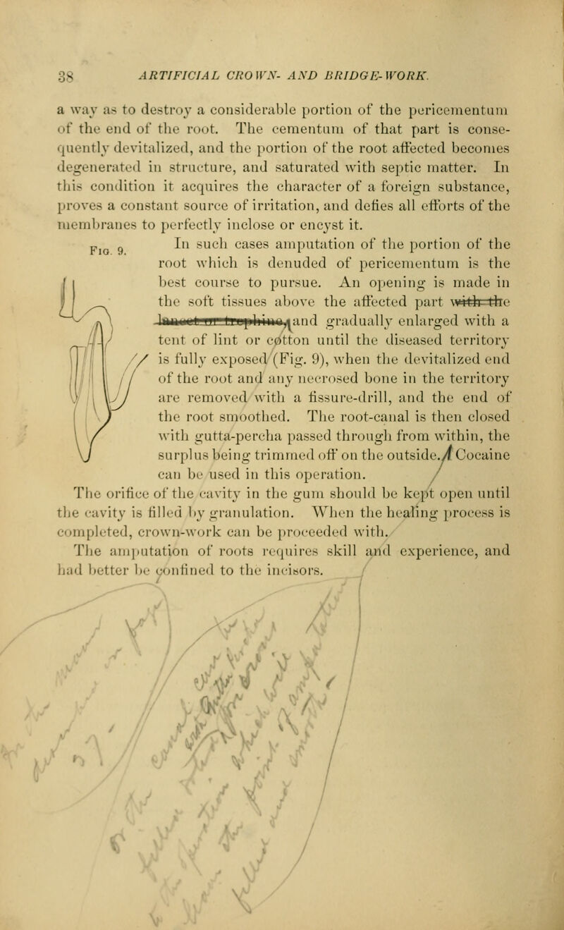 Flo. 9. a way as to destroy a considerable portion of the pericementum of the end of the root. The ceraentnni of that part is conse- quently devitalized, and the portion of the root affected becomes degenerated in structure, and saturated with septic matter. In this condition it acquires the character of a foreign substance, [•roves a constant source of irritation, and defies all efforts of the membranes to perfectly inclose or encyst it. In such cases amputation of the portion of the root which is denuded of pericementum is the I best course to pursue. An opening is made in ^^^ the soft tissues above the affected part wHlt-thc Ja***e*!aH=tBBpl*M*<»jand gradually enlarged with a tent of lint or cotton until the diseased territory is fully exposed (Fig. 9), when the devitalized end of the root and any necrosed bone in the territory are removed with a fissure-drill, and the end of the root smoothed. The root-canal is then closed with gutta-percha passed through from within, the surplus being trimmed off on the outsideyf Cocaine can be used in this operation. Tii'- orifice of the cavity in the gum should be kept open until the cavity is filled by granulation. When the healing process is completed, crown-work can be proceeded with. The amputation of roots requires skill and experience, and had better be confined to the incisors.