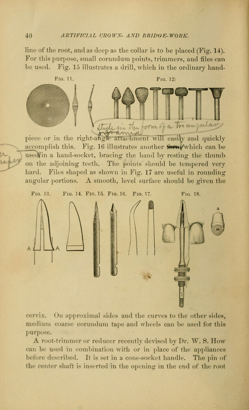 line of the root, and as deep as the collar is to be placed (Fig. 14). For this purpose, small corundum points, trimmers, and files can be used. Fig. 15 illustrates a drill, which in the ordinary hand- Fig. 12. Fig. 11 4vv 4-/U^^^^ai\[^ft^ piece or in the right-anglb attachment will easily and cpiickly aecomplish this. Fig. 16 illustrates another tfpw*/\vhich can be in a hand-soeket, bracing the hand by resting the thumb on the adjoining teeth. The points should be tempered very hard. Files shaped as shown in Fig. 17 are useful in rounding angular portions. A smooth, level surface should be given the Fig. 13. Fig. 14. Fio. 15. Fig. 16. Fio. V Fig. 18. * cervix. On approximal sides and the curves to the other sides, medium coarse corundum tape and wheels can be used for this purpose. A root-trimmer or reducer recently devised by Dr. W. S. How can be used in combination with or in place of the appliances before described. It is sel in a cone-sockel handle. The pin of the center shaft is inserted in the opening in the end of the root