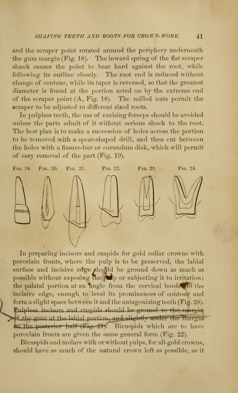 and the Scraper point rotated around the periphery underneath the gum margin (Fig. 18). The inward spring of the flat scraper shank causes the point to bear hard against the root, while following its outline closely. The root end is reduced without change of contour, while its taper is reversed, so that the greatest diameter is found at the portion acted on by the extreme end of the scraper point (A, Fig. 18). The milled nuts permit the scraper to he adjusted to different sized roots. In pulplesa teeth, the use of excising forceps should be avoided unless the parts admit of it without serious shock to the root. The best plan is to make a succession of holes across the portion to be removed with a spear-shaped drill, and then cut between the holes with a fissure-bur or corundum disk, which will permit of easy removal of the part (Fig. 19). Fig. 19. Fio. 20. Fio. 21. Fig. 22. Fig. 23. Fig. 24. In preparing incisors and cuspids for gold collar crowns with porcelain fronts, where the pulp is to be preserved, the labial surface and incisive edge /hofild be ground down as much as possible without exposing the,plflp or subjecting it to irritation; the palatal portion at an ^ngle from the cervical borde^fto'the incisive edge, enough to level its prominences of contour and form a slight space between it and the antagonizing teeth (Fig. 20). pulpier inci*nr>; nrwl r-n^pwla alwinlfl hr> frrnnnrl tn *li n inn p«\,) tlie gm-ii v\t flip i-ii.;-ii pru.tirni■, niifj lilirhll i 11111ff*^TffarrrTF*nT n the pirtH'i'r h:ilf (Fii, nVj Bicuspids which are to have porcelain fronts are given the same general form (Fig. 22). Bicuspids and molars with or without pulps, for all-gold crowns, should have as much of the natural crown left as possible, as it