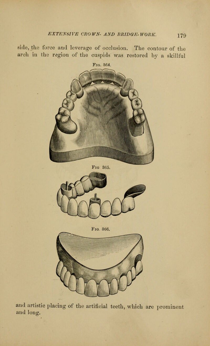 side, the force and leverage of occlusion. The contour of the arch in the region of the cuspids was restored by a skillful Fio. 364. Fig. 366. and artistic placing of the artificial teeth, which are prominent and Ion2.