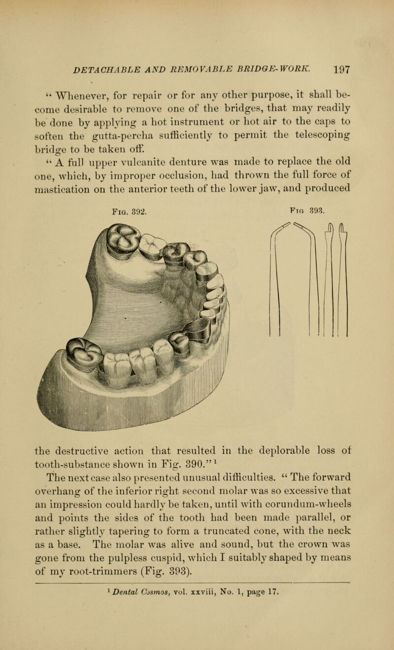 • Whenever, for repair or for any other purpose, it shall be- come desirable to remove one of the bridges, that may readily be done by applying a hot instrument or hot air to the caps to soften the gutta-percha sufficiently to permit the telescoping bridge to be taken off.  A full upper vulcanite denture was made to replace the old one, which, by improper occlusion, had thrown the full force of mastication on the anterior teeth of the lower jaw, and produced Fig. 392. Fio 393. the destructive action that resulted in the deplorable loss of tooth-substance shown in Fig. 390. * The next case also presented unusual difficulties.  The forward overhang of the inferior right second molar was so excessive that an impression could hardly be taken, until with corundum-wheels and points the sides of the tooth had been made parallel, or rather slightly tapering to form a truncated cone, with the neck as a base. The molar was alive and sound, but the crown was gone from the pulpless cuspid, which I suitably shaped by means of my root-trimmers (Fig. 393).