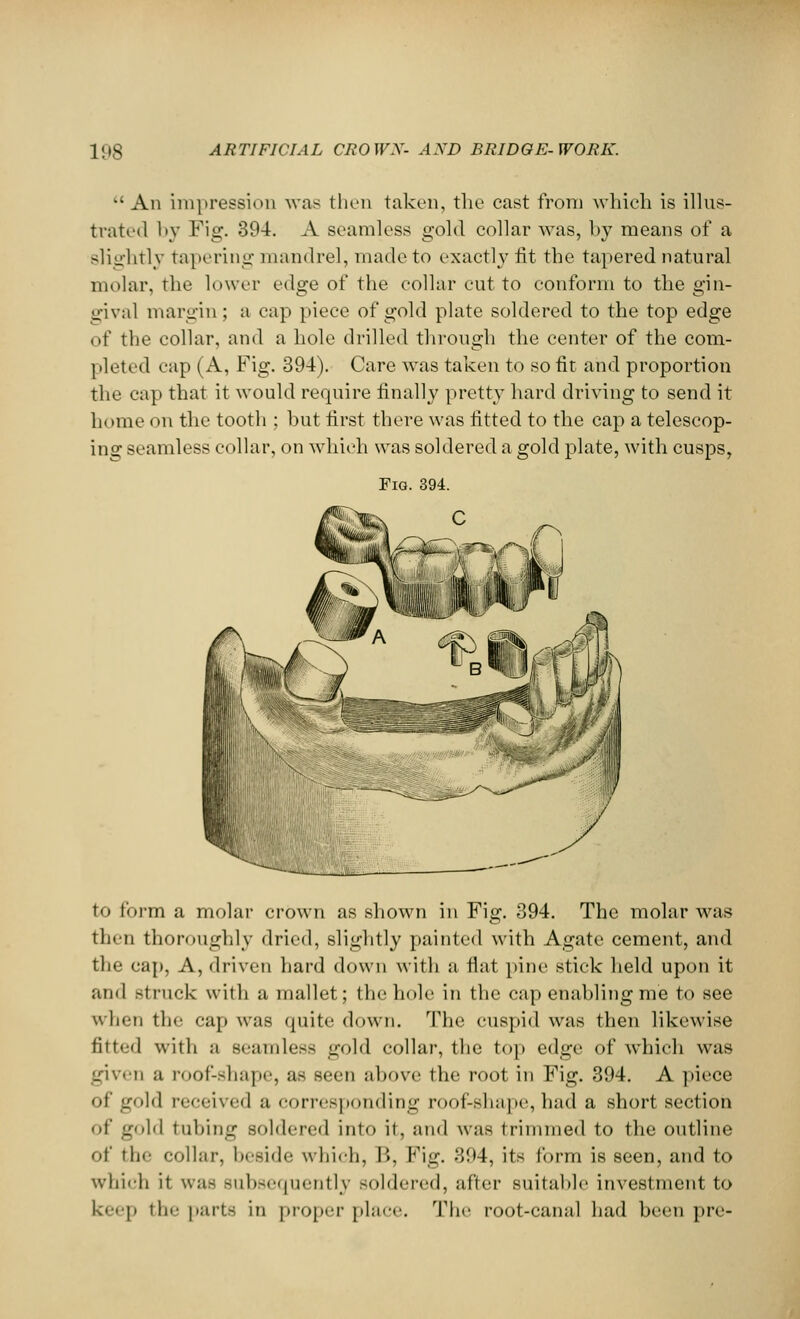 'An impression was then taken, the cast from which is illus- trated by Pig. 394. A seamless gold collar was, by means of a slightly tapering mandrel, made to exactly lit the tapered natural molar, the lower edge of the collar cut to conform to the gin- gival margin; a cap piece of gold plate soldered to the top edge of the collar, and a hole drilled through the center of the com- pleted cap (A, Fig. 394). Care was taken to so fit and proportion the cap that it would require finally pretty hard driving to send it h< mie i >n the tooth ; but first there was fitted to the cap a telescop- ing seamless collar, on which was soldered a gold plate, with cusps, Fig. 394. to form a molar crown as shown in Fig. 394. The molar was then thoroughly dried, slightly painted with Agate cement, and the cap, A, driven hard down with a fiat pine stick held upon it and -truck with a mallet; the hole in the cap enabling me to see when the cap was quite down. The cuspid was then likewise fitted with ;i seamless gold collar, the top edge <>f which was given a roof-shape, as seen above the root in Fig. 394. A piece of gold received a corresponding roof-shape, had a short section '■I' gold tubing soldered into it, and was trimmed to the outline of the collar, beside which, I'., Fig. 394, its form is seen, and to which it was subsequently soldered, after suitable investment to keep the parts in proper place. The root-canal had been pre-