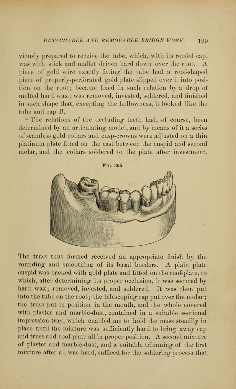 viouslv prepared to receive the tube, which, with its roofed cap, was with stick and mallet driven hard down over the root. A piece «>t' gold wire exactly fitting the tube had a roof-shaped piece of properly-perforated gold plate slipped over it into posi- tion on the root; became fixed in such relation by a drop of melted hard wax; was removed, invested, soldered, and finished in such shape that, excepting the hollowness, it looked like the tube and cap B.  The relations of the occluding teeth had, of course, been determined by an articulating model, and by means of it a series of seamless gold collars and cusp-crowns were adjusted on a thin platinum plate fitted on the cast between the cuspid and second molar, and the collars soldered to the plate after investment. Fig. 395. The truss thus formed received an appropriate finish by the rounding and smoothing of its basal borders. A plain plate cuspid was backed with gold plate and fitted on the roof-plate, to which, after determining its proper occlusion, it was secured by hard wax; removed, invested, and soldered. It was then put into the tube on the root; the telescoping cap put over the molar; the truss put in position in the mouth, and the whole covered with plaster and marble-dust, contained in a suitable sectional impression-tray, which enabled me to hold the mass steadily in place until the mixture was sufficiently hard to bring away cap and truss and roof-plate all in proper position. A second mixture of plaster and marble-dust, and a suitable trimming of the first mixture after all was hard, sufficed for the soldering process thai