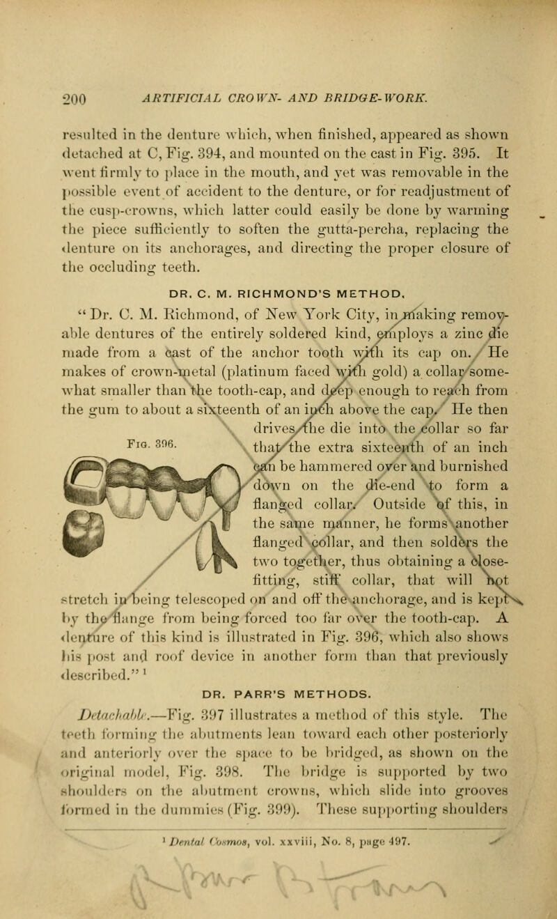 Fig. 3%. resulted in the denture which, when finished, appeared as shown detached at C, Fig. 394, and mounted on the cast in Fig. 395. It went firmly to place in the mouth, and yet was removable in the possible event of accident to the denture, or for readjustment of the eusp-erowns, which latter could easily be done by warming the piece sufficiently to soften the gutta-percha, replacing the denture on its anchorages, and directing the proper closure of the occluding teeth. DR. C. M. RICHMOND'S METHOD.  Dr. C. M. Richmond, of New York City, iii/Hiaking remov- able dentures of the entirely soldered kind, employs a zinc die made from a Cast of the anchor tooth wmi its cap on. He makes of crown-tnetal (platinum faced wmi gold) a collar/some- what smaller than\he tooth-cap, and ch?ep enough to reach from the gum to about a sixteenth of an inch above the cap,' He then he die into the collar so far aj/the extra sixteenth of an inch be hammered over and burnished on the die-end to form a collar/ Outside \£ this, in the same manner, he forms another flanged collar, and then solders the two together, thus obtaining a 6k>se- fitting, stiff collar, that will fwt stretch it/being telescoped on and off the anchorage, and is keptN by the flange from being forced too far over the tooth-cap. A denture of this kind is illustrated in Fig. 396, which also shows his j.ost and roof device in another form than that previously described.' DR. PARR'S METHODS. Detachable.—Fig. 397 illustrates a method of this Btyle. The teeth forming the abutments lean toward each other posteriorly and anteriorly over the space to be bridged, as shown on the original model. Pig. 398. The bridge is supported by two shoulders on the abutraenl crowns, which slide into grooves formed in the dummies (Fig. 399). These supporting shoulders