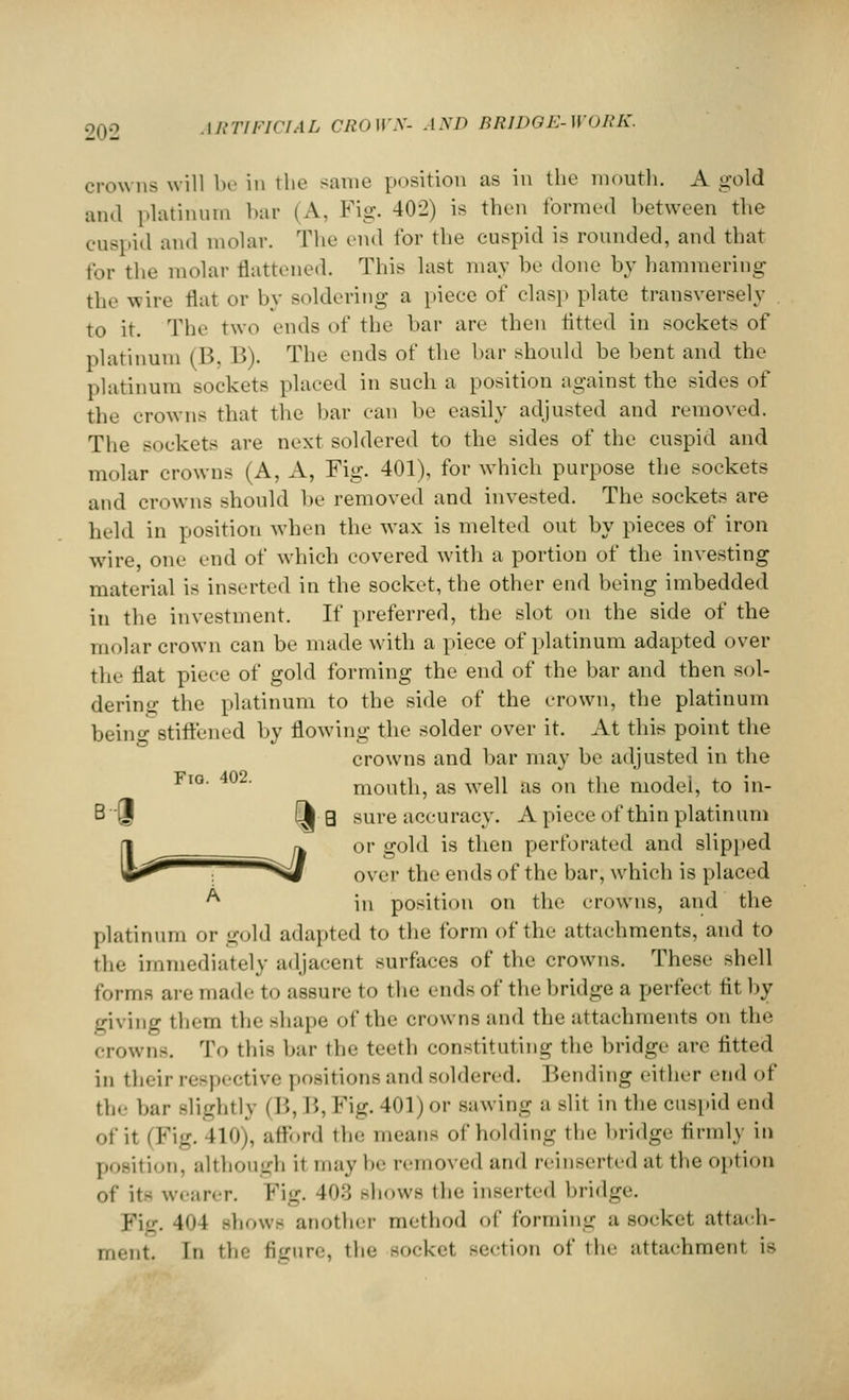 crowns will be in the same position as in the mouth. A gold and platinum bar (A, Fig. 402) is then formed between the cuspid and molar. The end for the cuspid is rounded, and that for the molar flattened. This last may be done by hammering the wire flat or by soldering a piece of clasp plate transversely to it. The two ends of the bar are then fitted in sockets of platinum (B, B). The ends of the bar should be bent and the platinum sockets placed in such a position against the sides of the crowns that the bar can be easily adjusted and removed. The sockets are next soldered to the sides of the cuspid and molar crowns (A, A, Fig. 401), for which purpose the sockets and crowns should be removed and invested. The sockets are held in position when the wax is melted out by pieces of iron wire, one end of which covered with a portion of the investing material is inserted in the socket, the other end being imbedded in the investment. If preferred, the slot on the side of the molar crown can be made with a piece of platinum adapted over the Hat piece of gold forming the end of the bar and then sol- dering the platinum to the side of the crown, the platinum being stiffened by flowing the solder over it. At this point the crowns and bar may be adjusted in the Fl0- 402' mouth, as well as on the modei, to in- B • J [| g sure accuracy. Apiece of thin platinum ri r^ or gold is then perforated and slipped '(Ji^ ;  -SJ over the ends of the bar, which is placed A in position on the crowns, and the platinum or gold adapted to the form of the attachments, and to the immediately adjacent surfaces of the crowns. These shell forms are made to assure to the ends of the bridge a perfect tit by giving them the shape of the crowns and the attachments on the crowns. To this bar the teeth constituting the bridge are fitted in their respective positions and soldered. Bending either end of the bar .lightly (B, B, Fig.401)or sawing a slit in the cuspid end of it (Fig. 410), afford the meane of holding the bridge firmly in position, although it may be removed and reinserted at the option of it- wearer. Fig. I;; shows the inserted bridge. Fig. 4ni showe another method of forming a socket attach- ments In tin- figure, Hie socket section of the attachment is