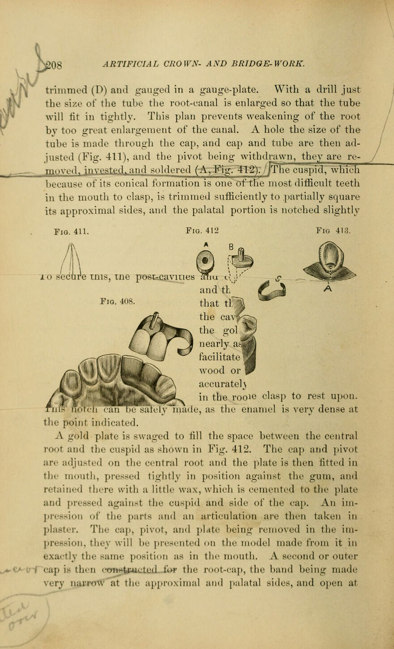 trimmed (D) and gauged in a gauge-plate. With a drill just the size of the tube the root-canal is enlarged so that the tube will tit in tightly. This plan prevents weakening of the root by too groat enlargement of the canal. A hole the size of the tube is made through the cap, and cap and tube are then ad- justed (Fig. 411), and the pivot being withdrawn, they are re- moved, invested, and soldered (A,-Fig. 31-2);//The cuspid,'which because of its conical formation is one of the most difficult teeth in the mouth to clasp, is trimmed sufficiently to partially square its approximal sides, and the palatal portion is notched slightly Fig. 411. I\\ Fig 413. Fig. 408. Fig. 412 A and th that tS the ca\ the gol nearly aJ| facilitate wood or accurately in the rooie clasp to rest upon. in- notch can Tie safely made, as the enamel is very dense at the point indicated. A -old plate is swaged to till the space between the central root and the cuspid as shown in Fig. 412. The cap and pivot are adjusted on the central root and the plate is then fitted in the mouth, pressed tightly in position against the gum, and retained there with a little wax, which is cemented to the plate and pressed against the cuspid and side of the cap. An im- pression of the parts and an articulation are then taken in plaster. The cap, pivot, and plate being removed in the im- pression, they will he presented on the model made from it in exactly the same position ;i- in the mouth. A second or outer cap i- then ctmH&picted for tin' root-cap, the band being made very narrow at the approximal and palatal sides, and open at