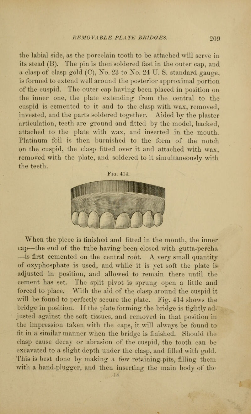 the labial side, as the porcelain tooth to be attached will serve in its stead (B). The pin is then soldered fast in the outer cap, and a clasp of clasp gold (C), No. 23 to No. 24 U. S. standard gauge, is formed to extend well around the posterior approximal portion of the cuspid. The outer cap having been placed in position on the inner one, the plate extending from the central to the cuspid is cemented to it and to the clasp with wax, removed, invested, and the parts soldered together. Aided by the plaster articulation, teeth are ground and fitted by the model, backed, attached to the plate with wax, and inserted in the mouth. Platinum foil is then burnished to the form of the notch on the cuspid, the clasp fitted over it and attached with wax, removed with the plate, and soldered to it simultaneously with the teeth. Fig. 414. When the piece is finished and fitted in the mouth, the inner cap—the end of the tube having been closed with gutta-percha —is first cemented on the central root. A very small quantity of oxyphosphate is used, and while it is yet soft the plate is adjusted in position, and allowed to remain there until the cement has set. The split pivot is sprung open a little and forced to place. With the aid of the clasp around the cuspid it will be found to perfectly secure the plate. Fig. 414 shows the bridge in position. If the plate forming the bridge is tightly ad- justed against the soft tissues, and removed in that position in the impression taken with the caps, it will always be found to tit in a similar manner when the bridge is finished. Should the clasp cause decay or abrasion of the cuspid, the tooth can be excavated to a slight depth under the clasp, and filled with gold. This is best done by making a few retaining-pits, filling them with a hand-plugger, and then inserting the main body of the 14