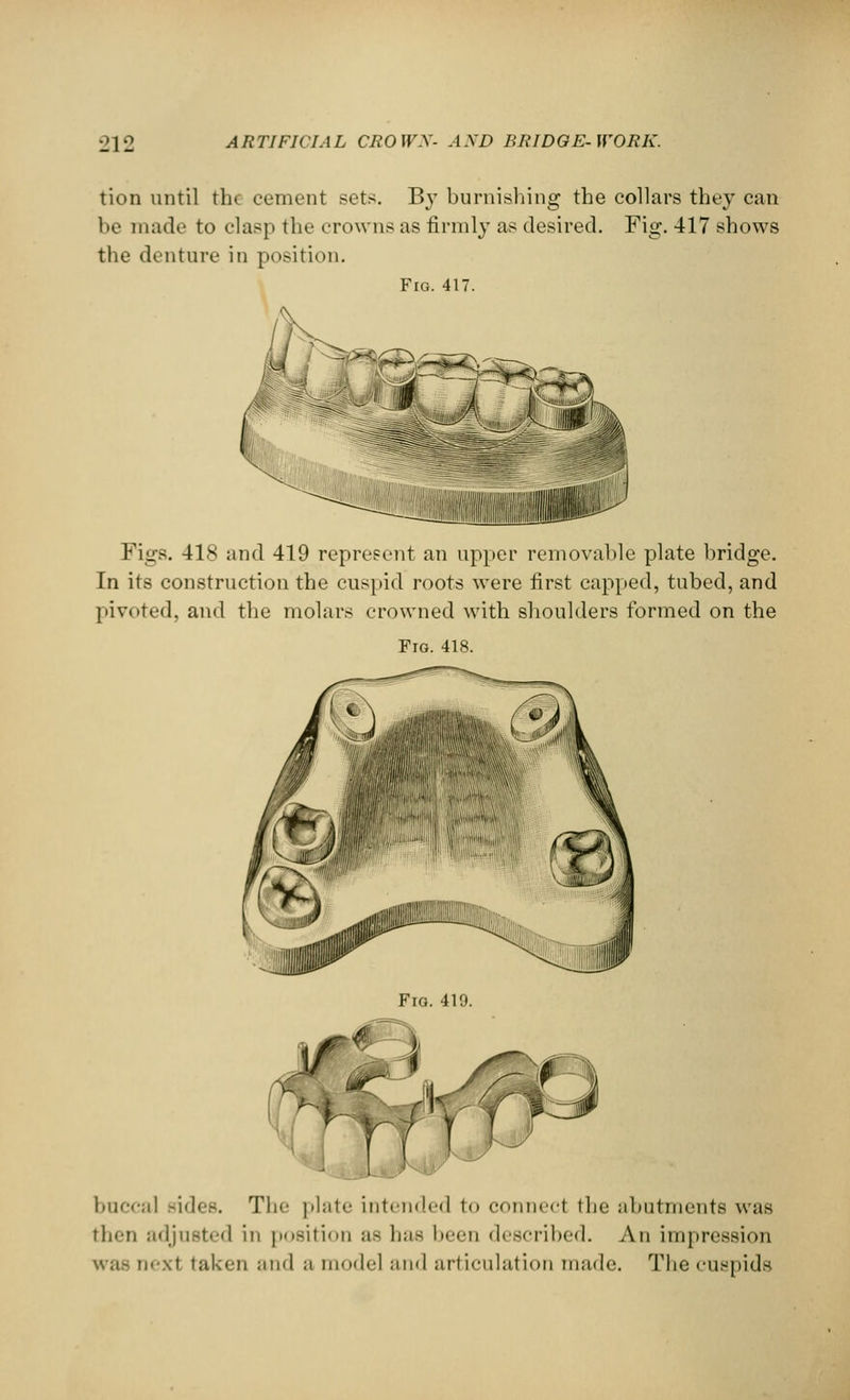 tion until the cement sets. By burnishing the collars they can be made to clasp the crowns as firmly as desired. Fig. 417 shows the denture in position. Fig. 417. Figs. 418 and 419 represent an upper removable plate bridge. In its construction the cuspid roots were first capped, tubed, and pivoted, and the molars crowned with shoulders formed on the Fig. 418. Fig. 419. buccal Bides. The plate Intended to conned the abutments was then adjusted in position as 1ms been described. An impression was ii'\t taken and a model and articulation made. The cuspids