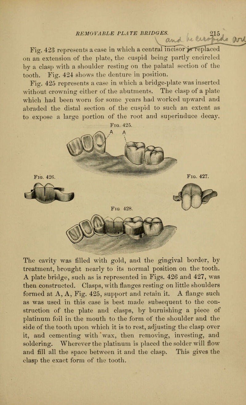 Fig. 423 represents a case in which a central incisor jtrfeplaced «>n an extension of the plate, the cuspid being partly encircled by a clasp with a shoulder resting on the palatal section of the tooth. Fig. 424 shows the denture in position. Fig. 425 represents a case in which a bridge-plate was inserted without crowning either of the abutments. The clasp of a plate which had been worn for some years had worked upward and abraded the distal section of the cuspid to such an extent as to expose a large portion of the root and superinduce decay. Fia. 425. A A The cavity was filled with gold, and the gingival border, by treatment, brought nearly to its normal position on the tooth. A plate bridge, such as is represented in Figs. 426 and 427, was then constructed. Clasps, with flanges resting on little shoulders formed at A, A, Fig. 425, support and retain it. A flange such as was used in this case is best made subsequent to the con- struction of the plate and clasps, by burnishing a piece of platinum foil in the mouth to the form of the shoulder and the side of the tooth upon which it is to rest, adjusting the clasp over it, and cementing with wax, then removing, investing, and soldering. Wherever the platinum is placed the solder will flow and fill all the space between it and the clasp. This gives the clasp the exact form of the tooth.