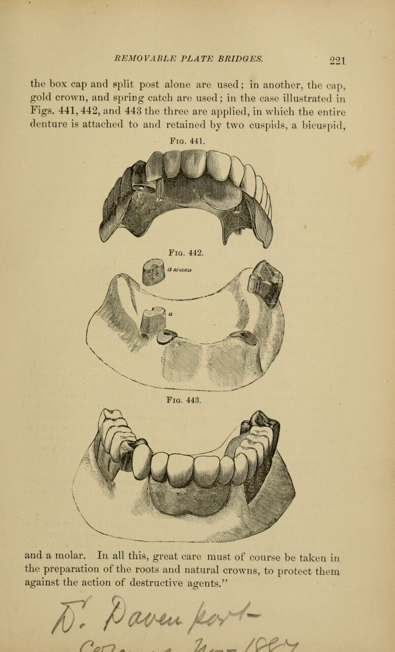 thf box cap and split post alone are used; in another, the cup. gold crown, and sprirjg catch are used; in the case illustrated in Figs. 441,442, and 443 the three are applied, in which the entire denture is attached to and retained by two cuspids, a bicuspid, Fig. 441. and a molar. In all this, great care must of course be taken in the preparation of the roots and natural crowns, to protect them against the action of destructive agents.