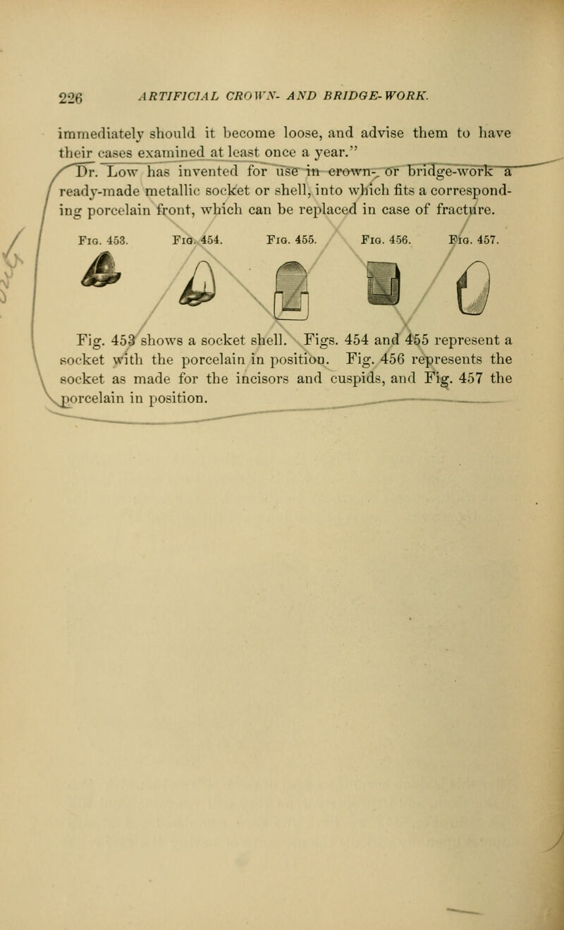 immediately should it become loose, and advise them to have their cases examined jit least once a year. Dr. Low has invented for use in crown-, or bridge-work a ready-made metallic socket or shell, into which fits a correspond- ing porcelain front, which can be replaced in case of fracture. Fig. 453. Fig. 454. Fig. 455. Fig. 456. Fig. 457. / Fig. 45£ shows a socket shell. Figs. 454 and 455 represent a socket with the porcelain in position. Fig. 456 represents the socket as made for the incisors and cuspids, and Fig. 457 the jorcelain in position.