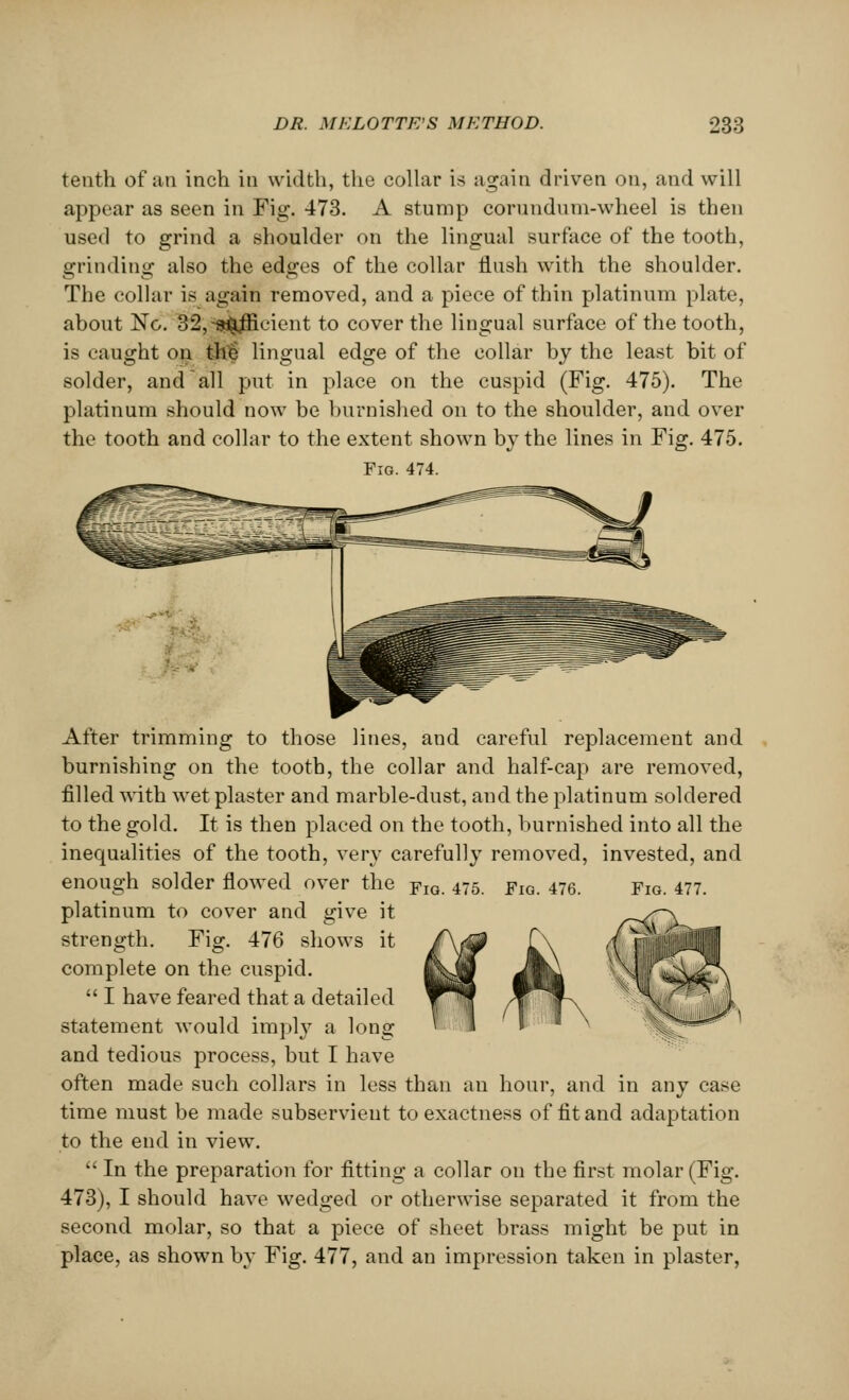 tenth of an inch in width, the collar is again driven on, and will appear as seen in Fig. 473. A stump corundum-wheel is then used to grind a shoulder on the lingual surface of the tooth, grinding also the edges of the collar flush with the shoulder. The collar is again removed, and a piece of thin platinum plate, about No. 32,-sufficient to cover the lingual surface of the tooth, is caught on this lingual edge of the collar by the least bit of solder, and all put in place on the cuspid (Fig. 475). The platinum should now be burnished on to the shoulder, and over the tooth and collar to the extent shown by the lines in Fig. 475. Fig. 474. After trimming to those lines, and careful replacement and burnishing on the tooth, the collar and half-cap are removed, filled with wet plaster and marble-dust, and the platinum soldered to the gold. It is then placed on the tooth, burnished into all the inequalities of the tooth, very carefully removed, invested, and enough solder flowed over the FlG. 475 FlG. 476. FlG 477- platinum to cover and give it strength. Fig. 476 shows it complete on the cuspid.  I have feared that a detailed statement would imply a long '< 1 • =*** and tedious process, but I have often made such collars in less than an hour, and in any case time must be made subservient to exactness of fit and adaptation to the end in view.  In the preparation for fitting a collar on the first molar (Fig. 473), I should have wedged or otherwise separated it from the second molar, so that a piece of sheet brass might be put in place, as shown by Fig. 477, and an impression taken in plaster,