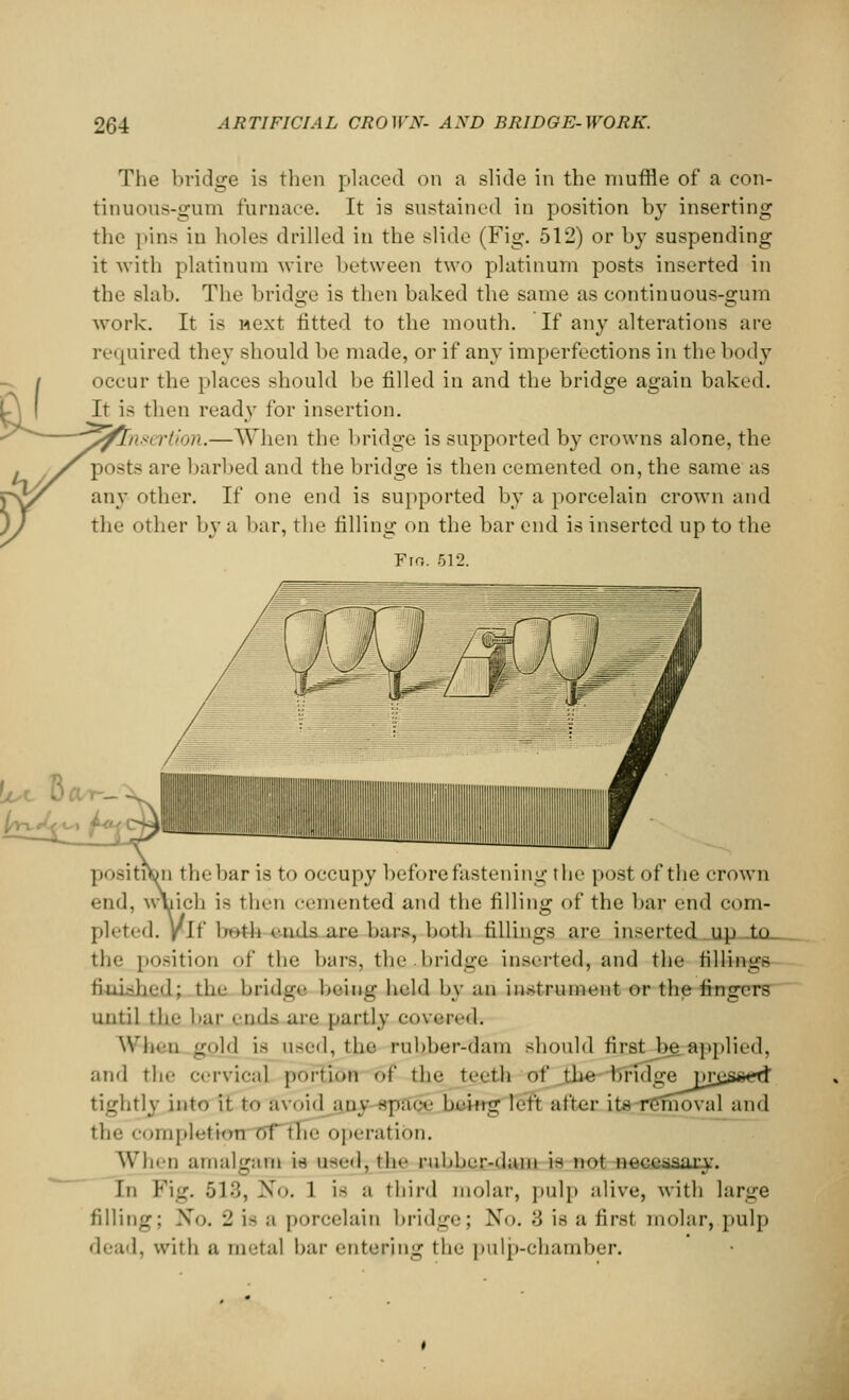 - / OC The bridge is then placed on a slide in the muffle of a con- tinuous-gum furnace. It is sustained in position by inserting the pins in holes drilled in the slide (Fig. 512) or by suspending it with platinum wire between two platinum posts inserted in the slab. The bridge is then baked the same as continuous-gum work. It is next fitted to the mouth. If any alterations are required they should be made, or if any imperfections in the body occur the places should be filled in and the bridge again baked. It is then ready for insertion. ,, v, rtion.—When the bridge is supported by crowns alone, the posts are barbed and the bridge is then cemented on, the same as any other. If one end is supported by a porcelain crown and the other by a bar, the filling on the bar end is inserted up to the Fro. 512. positron the bar is to occupy before fastening the post of the crown end, wuich is thm cemented and the filling of the bar end com- pleted, ylt' both ends are bars, both fillings are inserted up to the position of the bars, the bridge inserted, and the fillings liui-hed; the bridge being held by an instrument or the fingers until tie- hat ends a£fi partly covered. When ifold is used, the rubber-dam should first be applied, and tli.' cervical porEdn of the teeth of the bridge nresstfd' tightly into it to avoid any spSQg bring left after it* removal and the completion of the operation. When amalgam in useel^the rubber-dam is not noffftjfiary Tn Fig. 513, No. 1 is a third molar, pulp alive, with large filling; No. 2 ifl a porcelain bridge; Xo. :', is a first molar, pulp dead, with a metal bar entering the pulp-chamber.