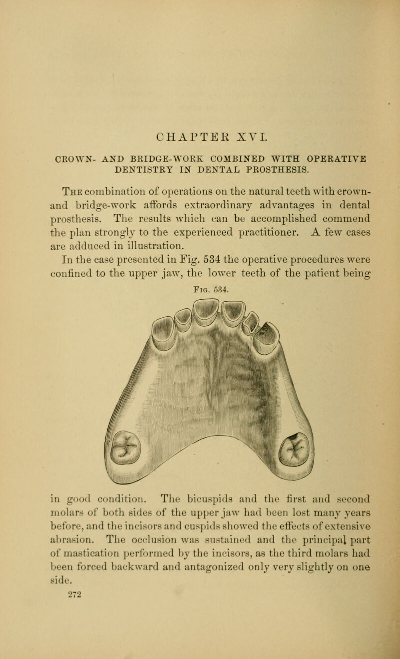 CHAPTER XVI. CROWN- AND BRIDGE-WORK COMBINED WITH OPERATIVE DENTISTRY IN DENTAL PROSTHESIS. The combination of operations on the natural teeth with crown- and bridge-work affords extraordinary advantages in dental prosthesis. The results which can be accomplished commend the plan strongly to the experienced practitioner. A few cases are adduced in illustration. In the case presented in Fig. 53-4 the operative procedures were confined to the upper jaw, the lower teeth of the patient being Fig. 534. in good condition. The bicuspids and the first and second molars of both sides of the upper jaw bad been lost many years before, and the incisors and cuspids showed the effects of extensive abrasion. The occlusion was sustained and the principal part of mastication performed by the incisors, as the third molars had been forced backward and antagonized only very slightly on one side.